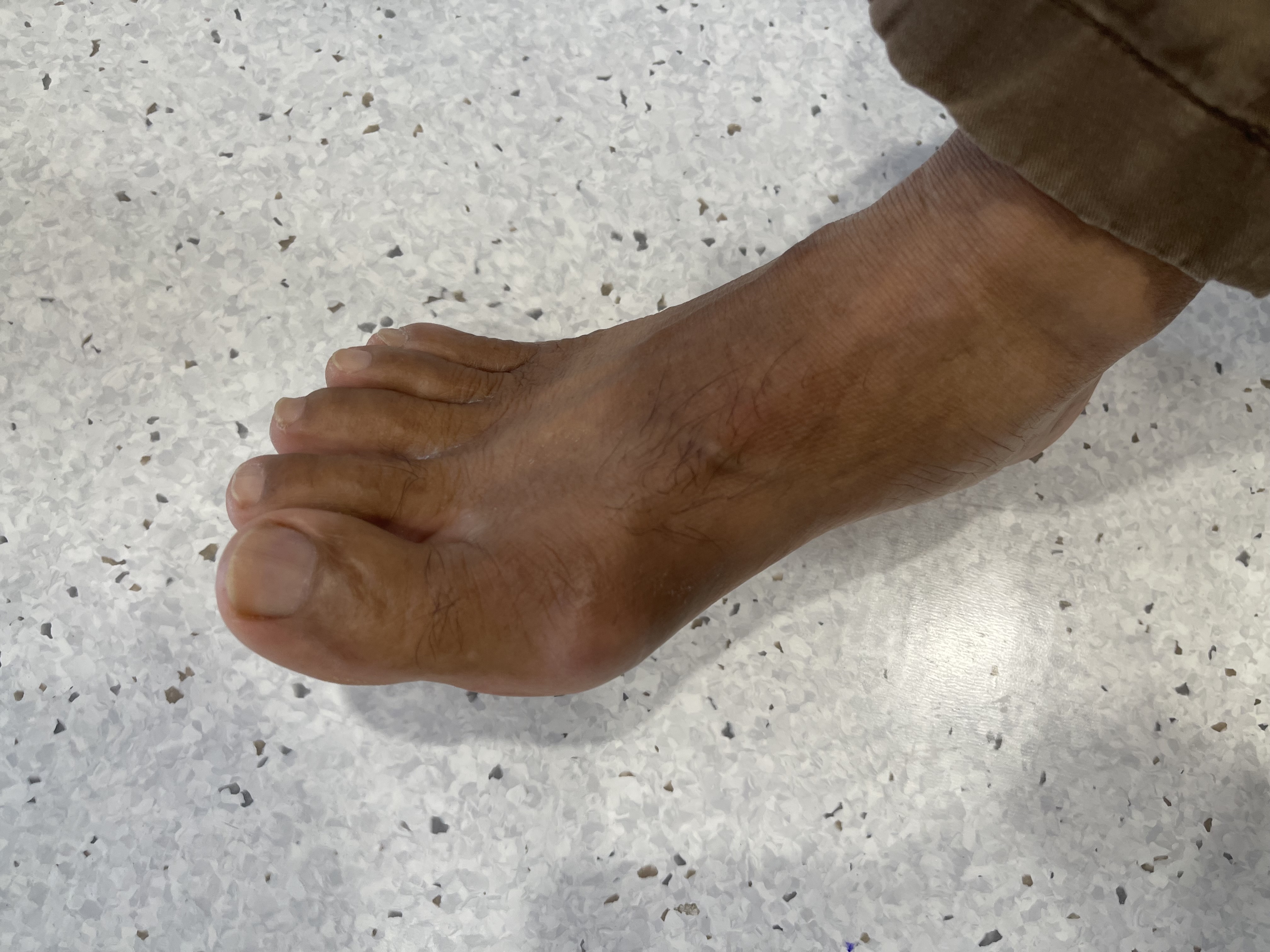 ปวดนิ้วโป้งเท้า: เก๊าท์ VS นิ้วเก (Hallux valgus)