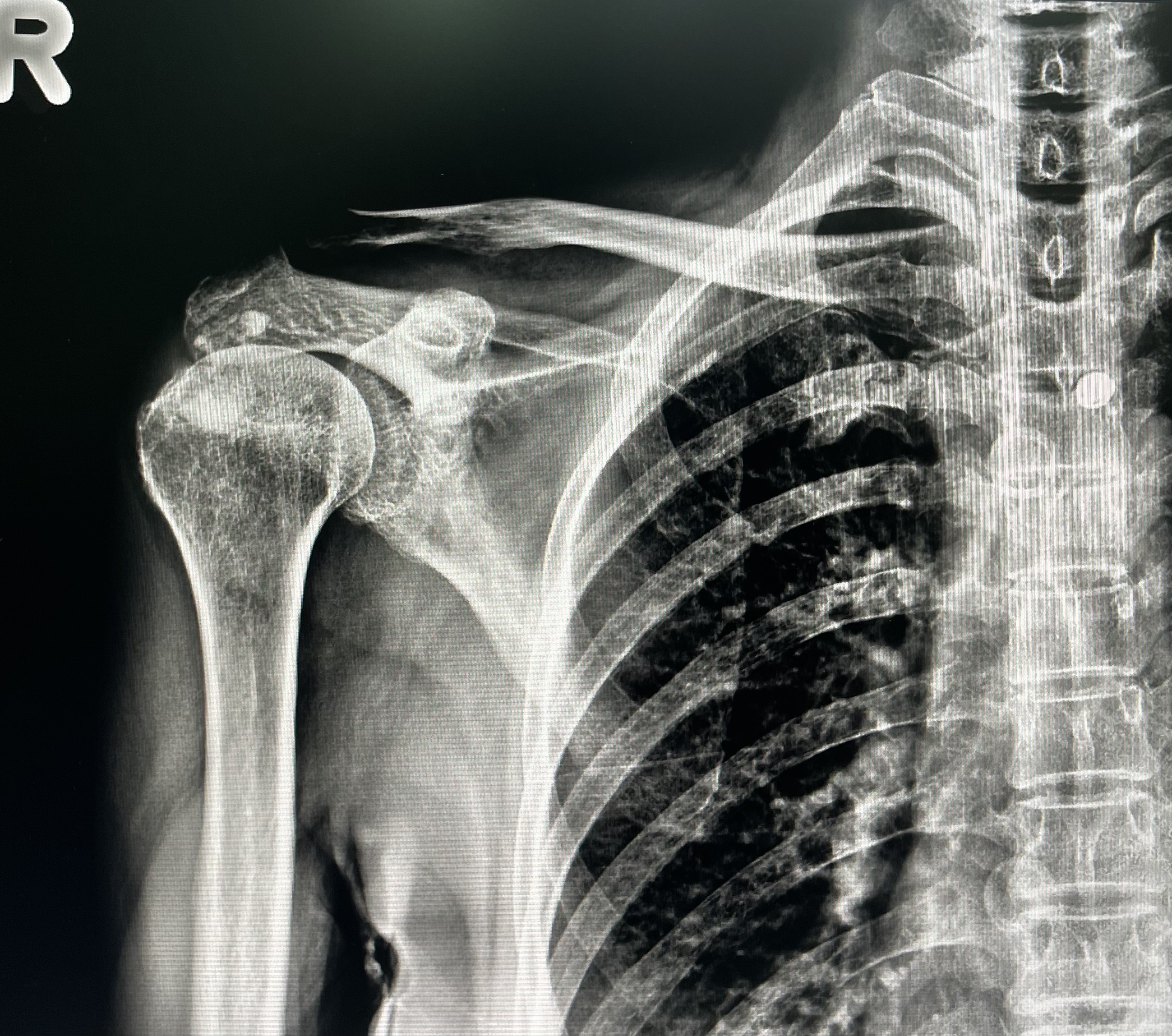 ปวดไหล่ ยกแขนไม่ขึ้น เพราะเอ็นไหล่มีหินปูน (Calcific tendinitis)