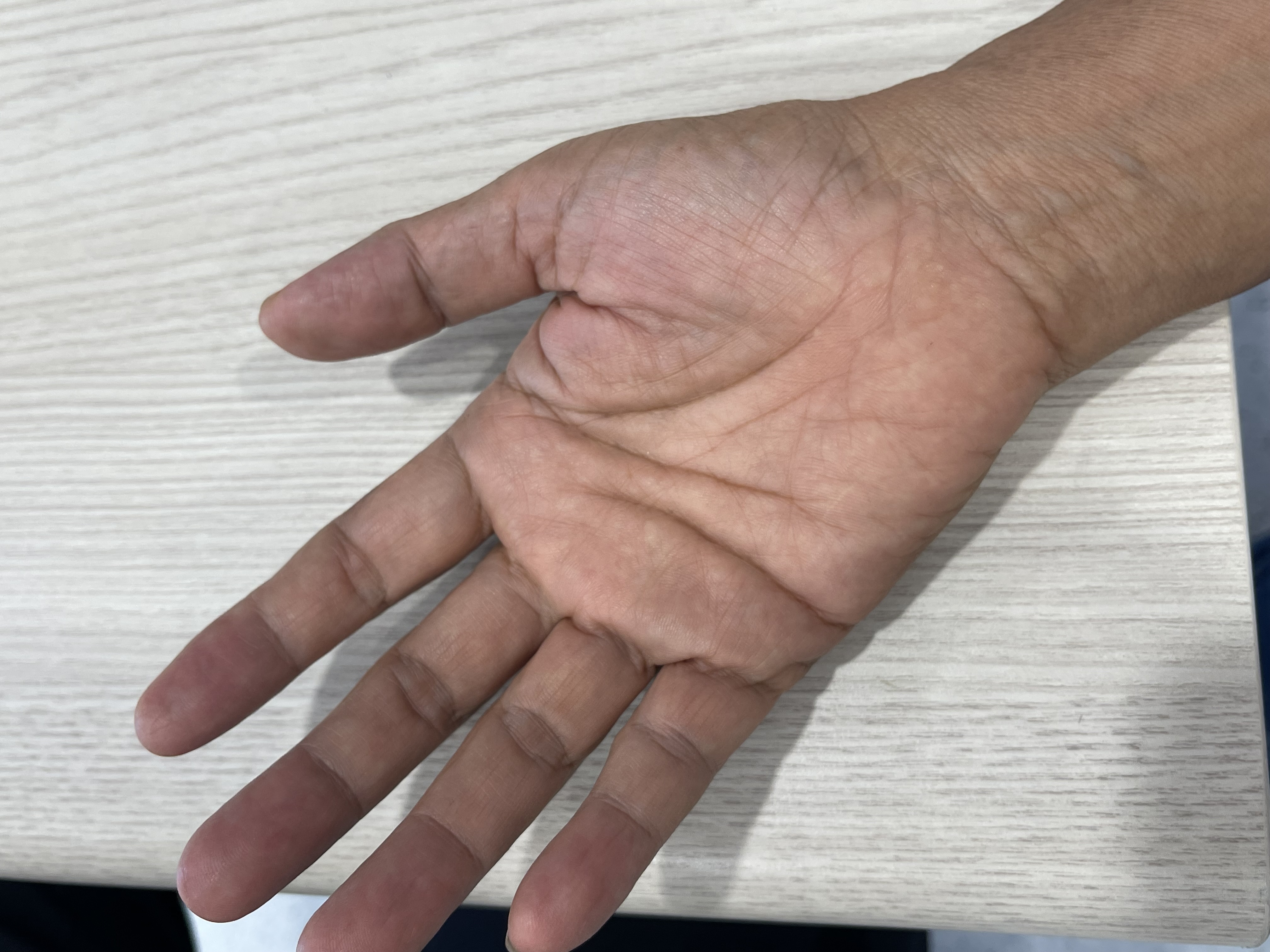 มือชา: สัญญาณ Carpal Tunnel Syndrome ที่คุณควรรู้
