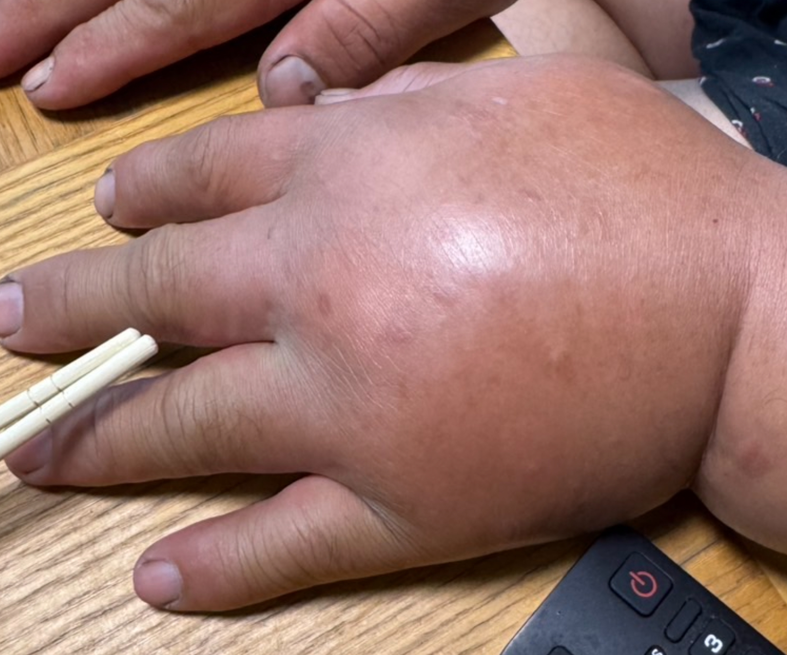 มือบวมมากผิดปกติ