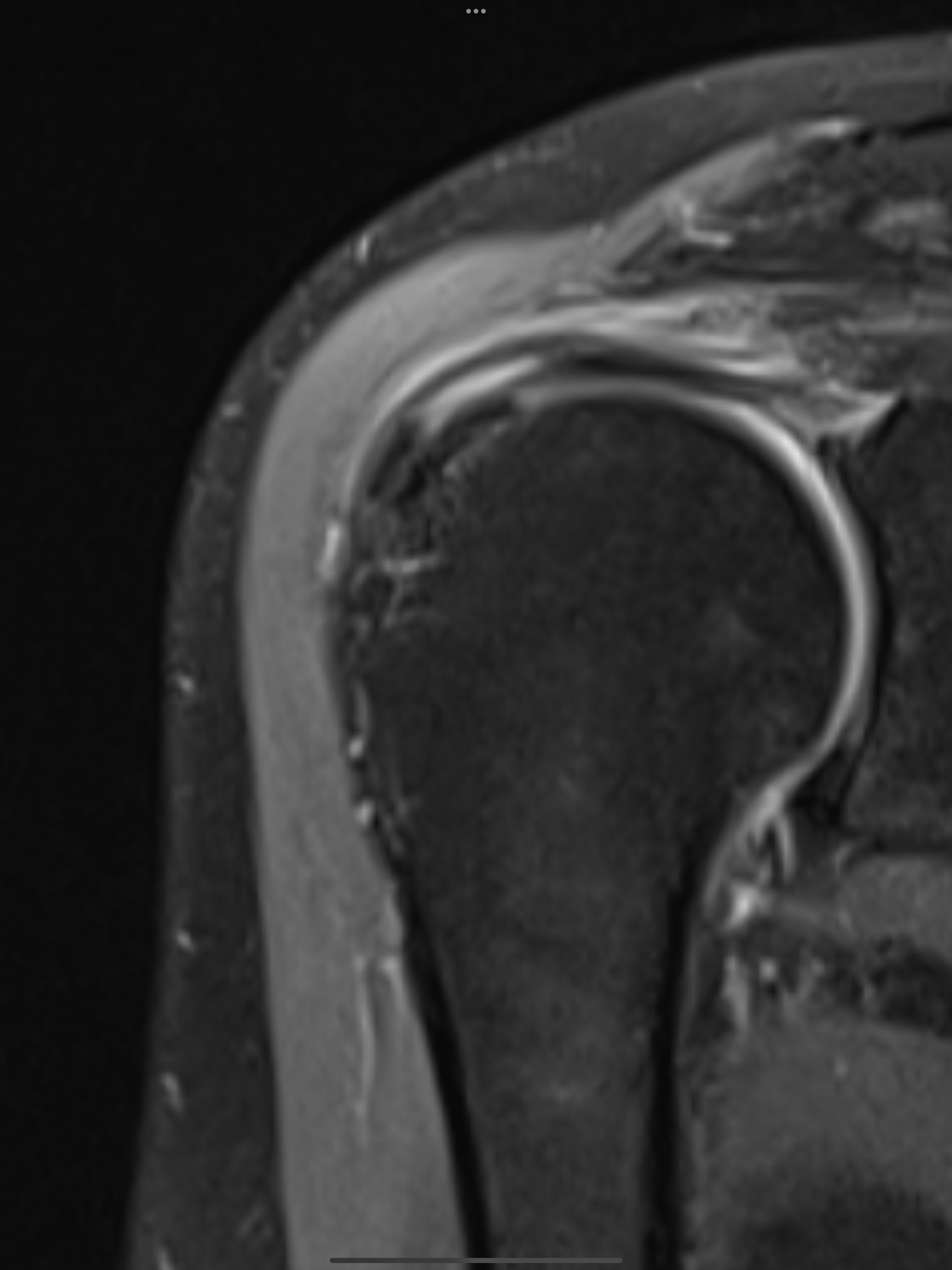 เมื่อไหร่ควรทำ MRI ของไหล่