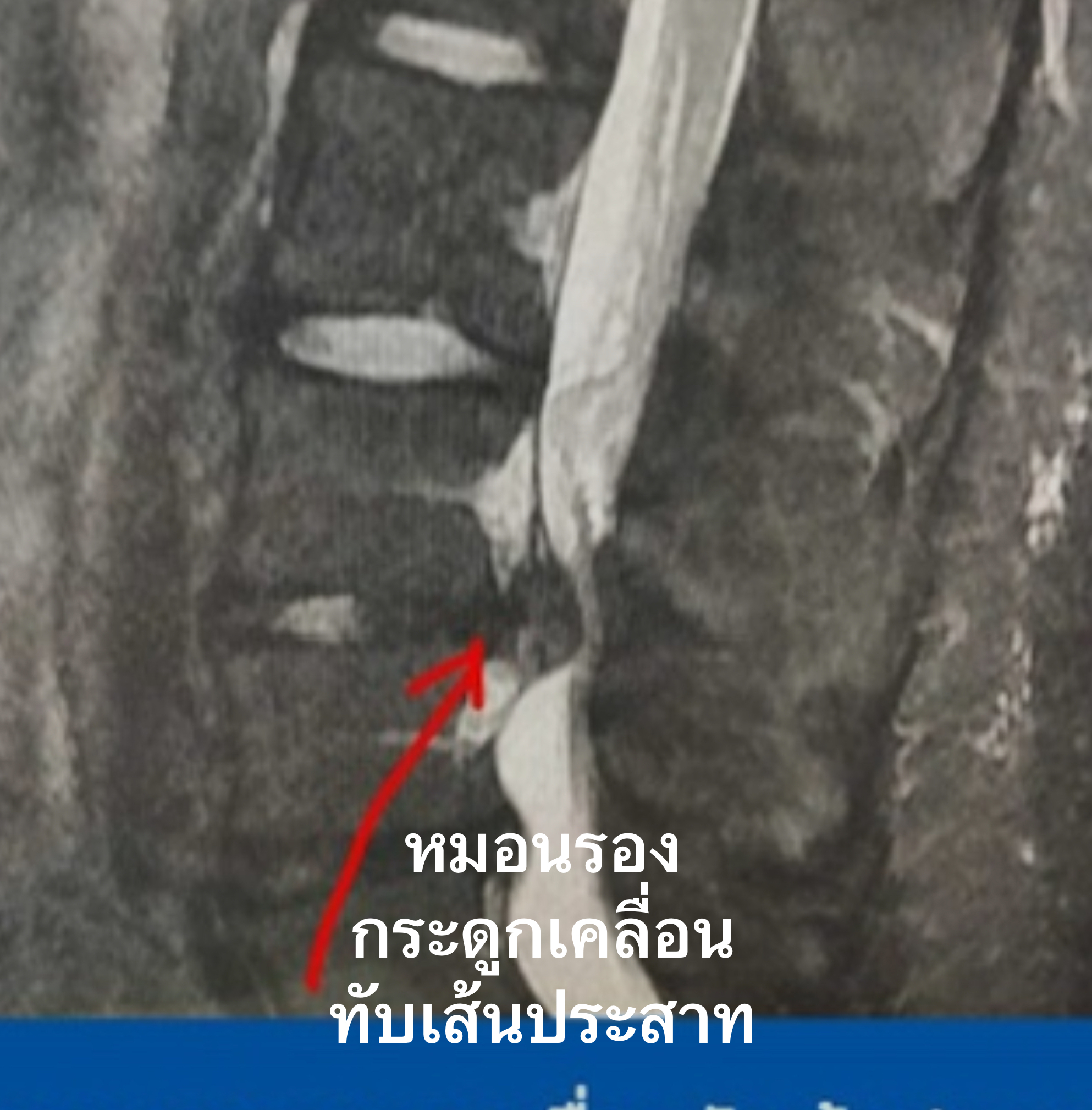 หมอนรองกระดูกสันหลังเสื่อม… หายได้ไหม? ต้องผ่าตัดหรือเปล่า?