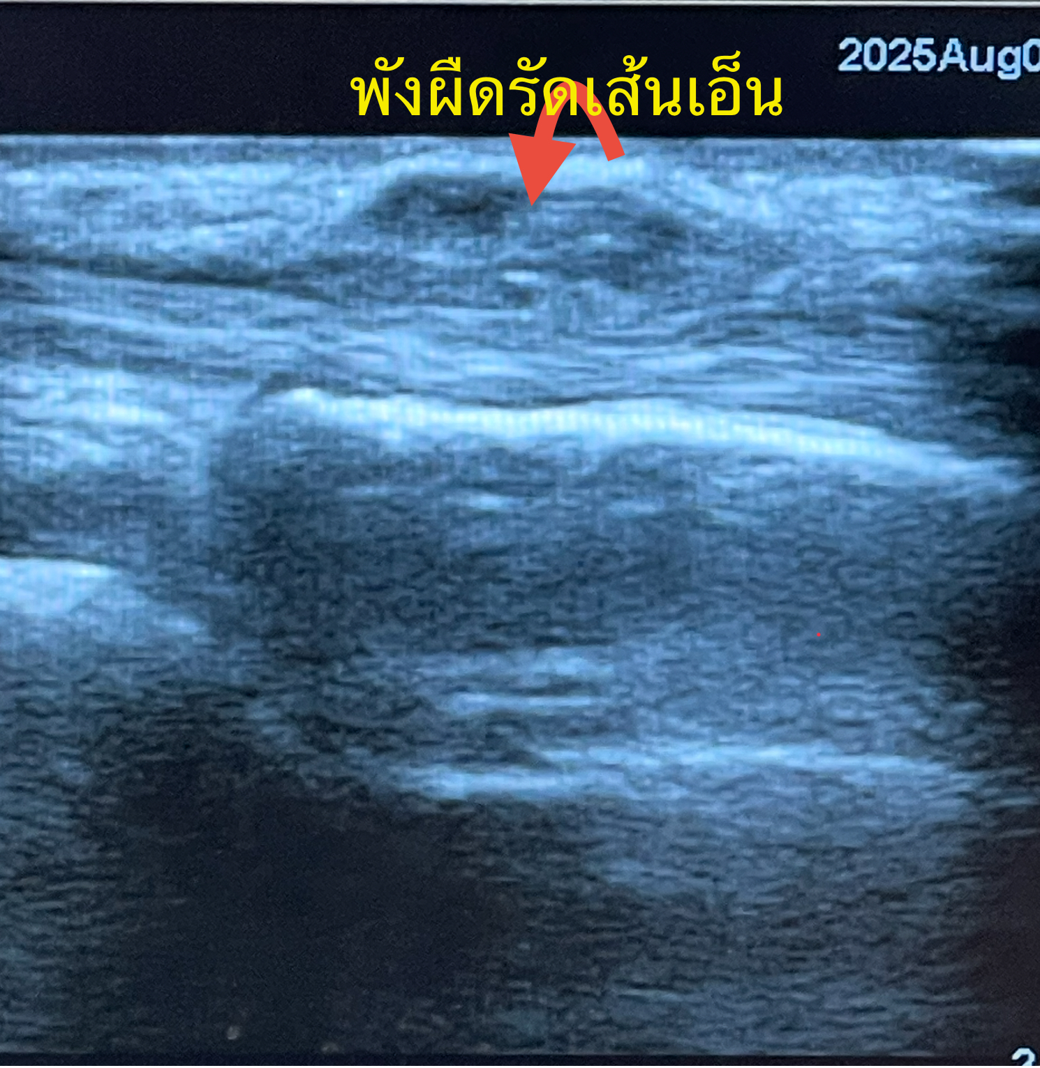 ปวดข้อมือด้านนิ้วโป้ง อย่าชะล่าใจ…อาจเป็น “De Quervain” รักษาได้โดยไม่ต้องผ่าตัด!