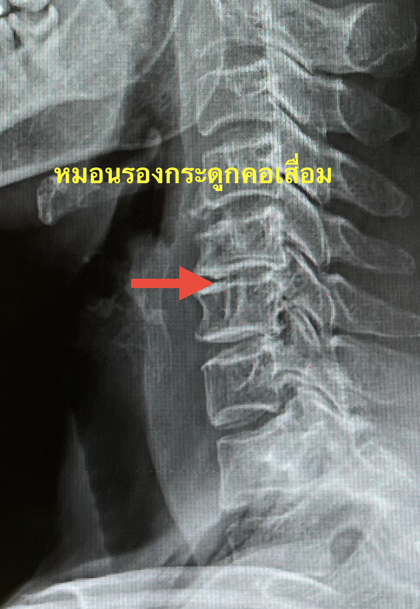 ปวดคอ ปวดบ่า ร้าวลงแขน… อย่ารอให้ชาไปทั้งมือ