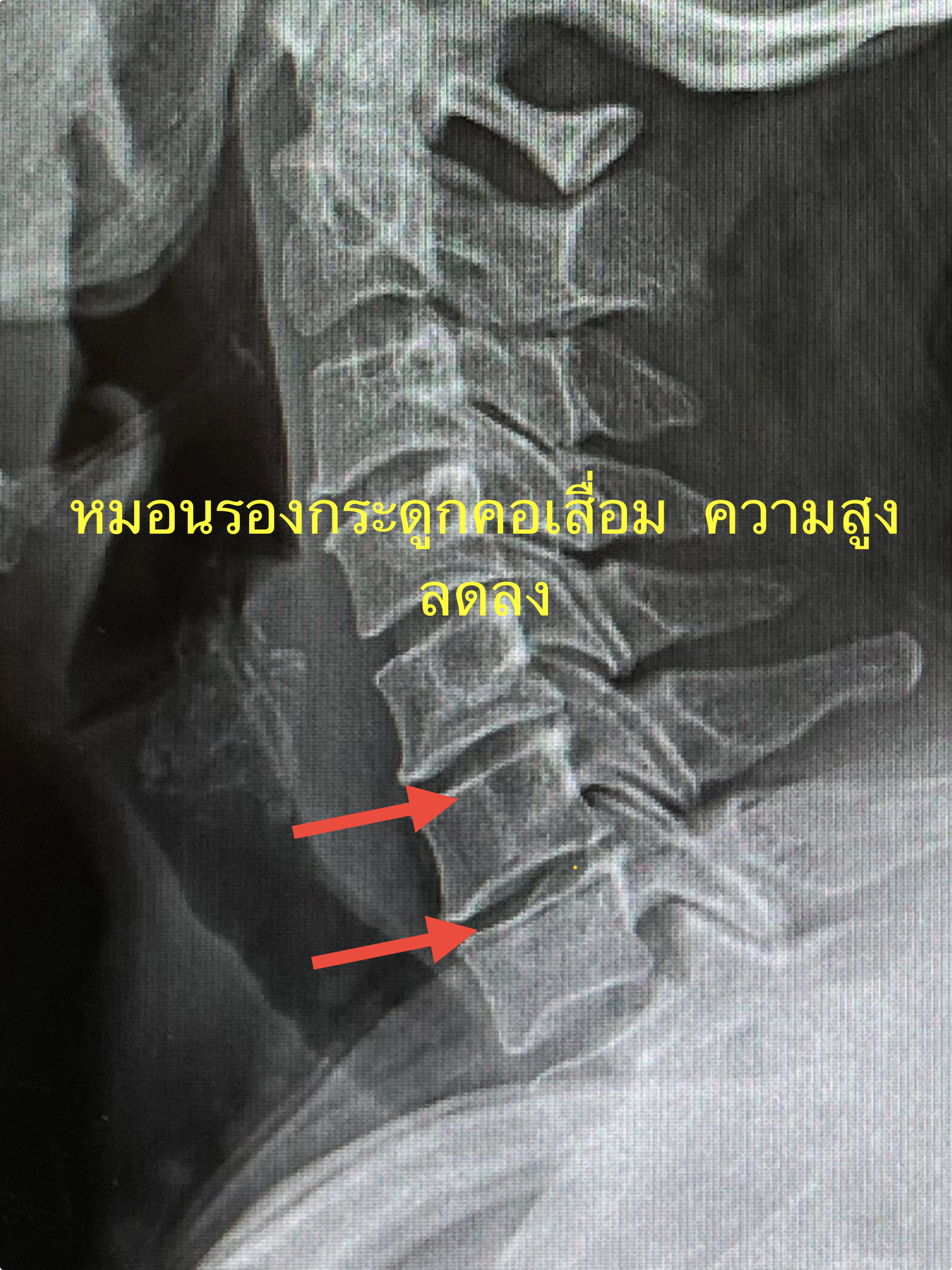 ปวดคอ ร้าวลงสะบักทั้งสองข้าง ใช่แค่เส้นตึง หรือหมอนรองกระดูกคอเริ่มเสื่อม?