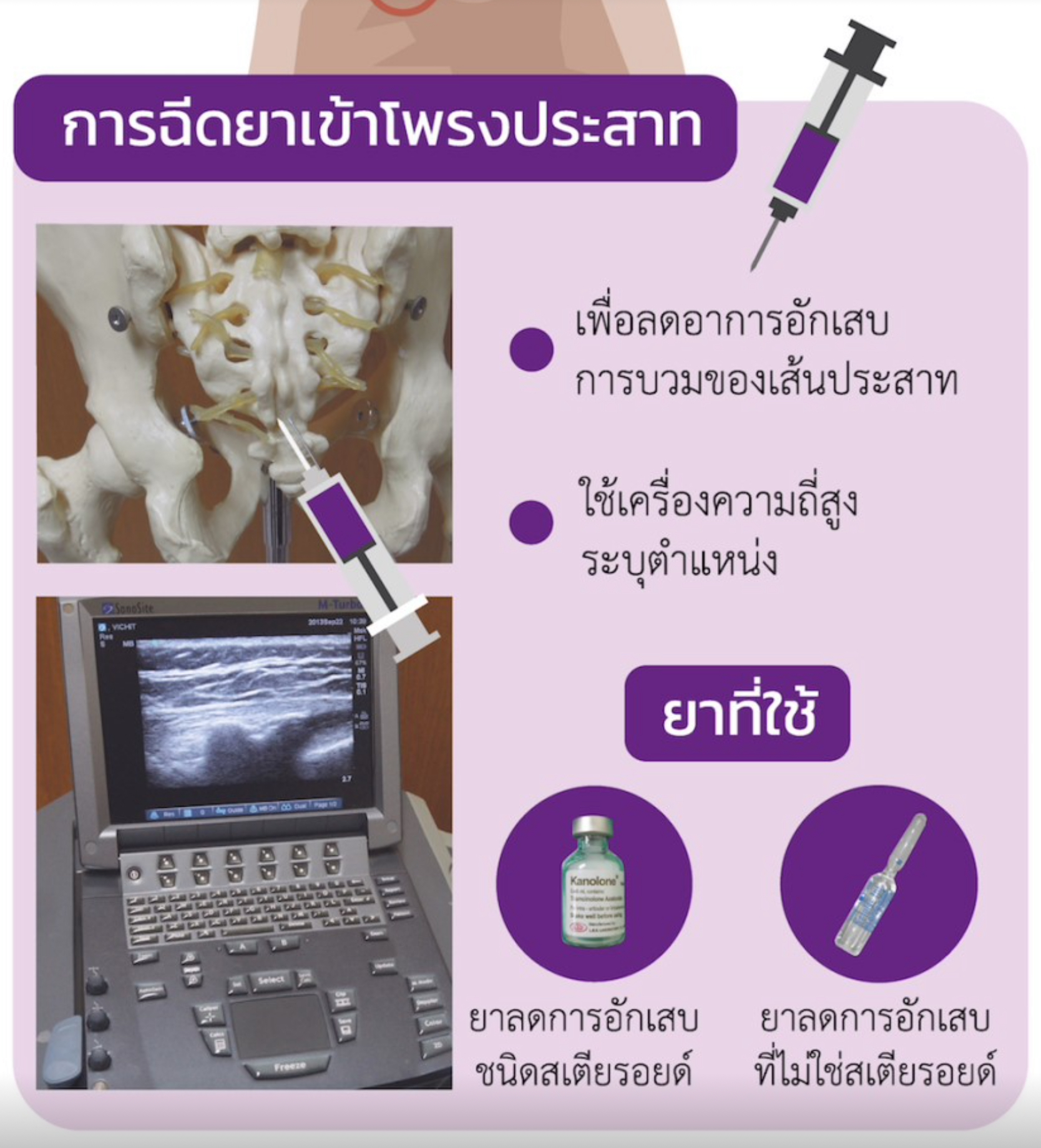 รู้จักการฉีดยารอบรากประสาท: ลดปวดหลัง ปวดร้าวลงขา