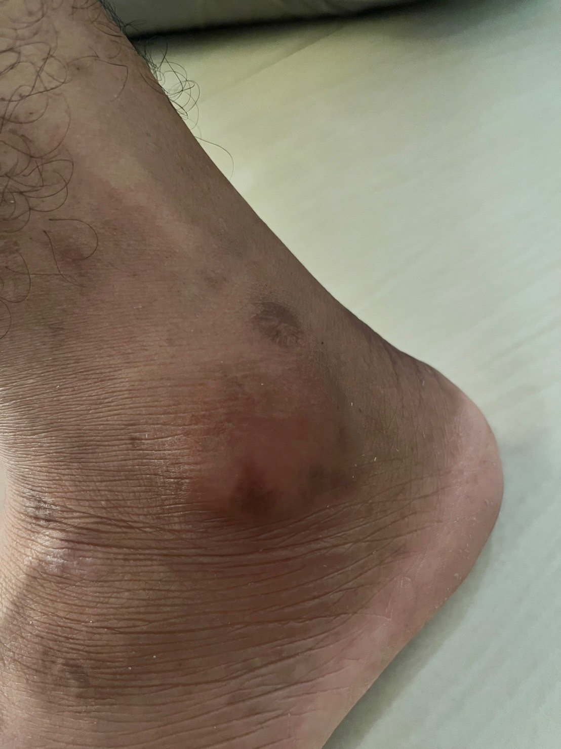 ถุงน้ำอักเสบที่ตาตุ่ม (Bursitis) เรื่องใกล้ตัวที่หลายคนมองข้าม