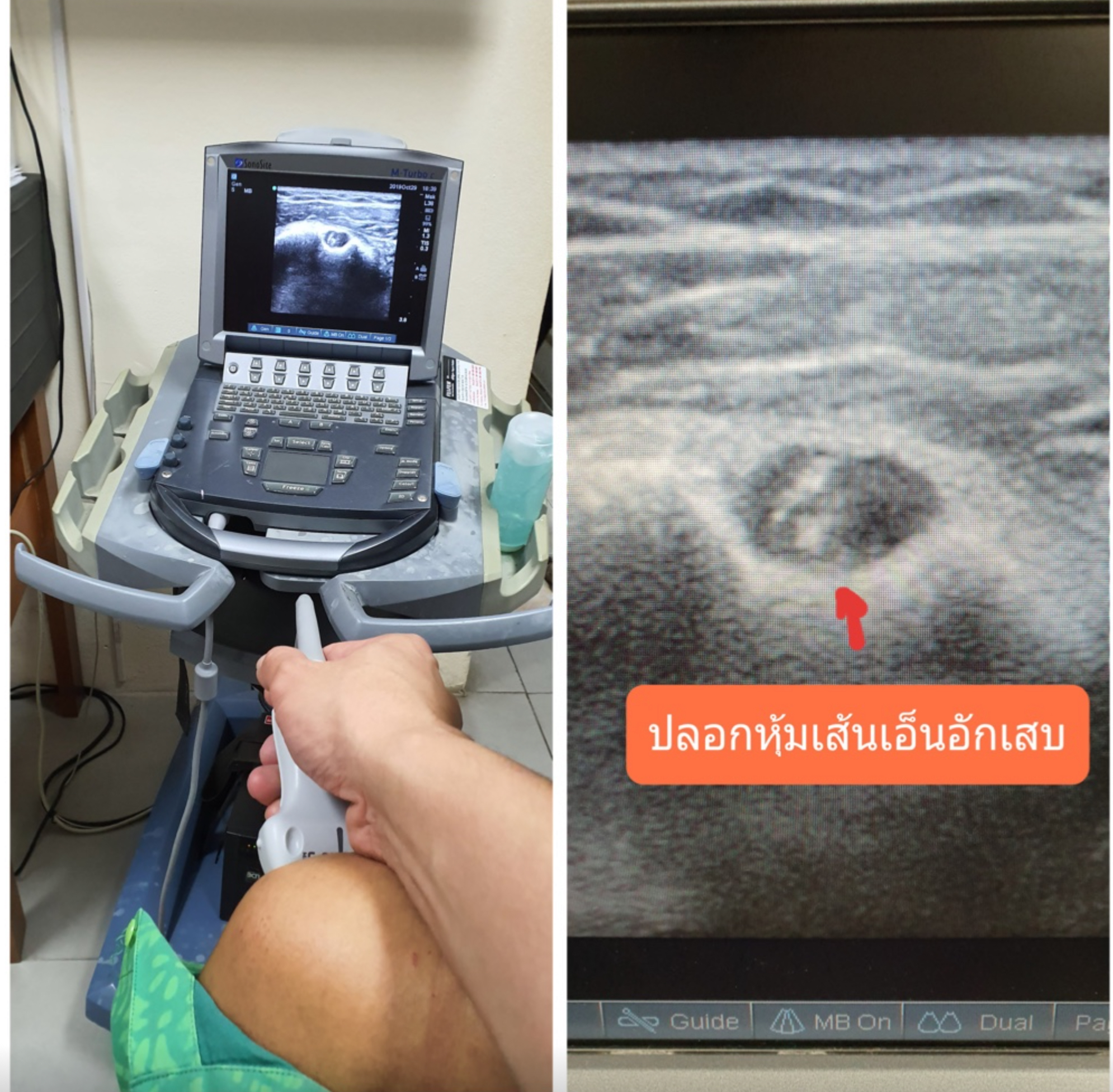 ปวดไหล่…อย่าด่วนสรุปว่าเป็นแค่กล้ามเนื้ออักเสบ ตรวจให้ชัดก่อนรักษา
