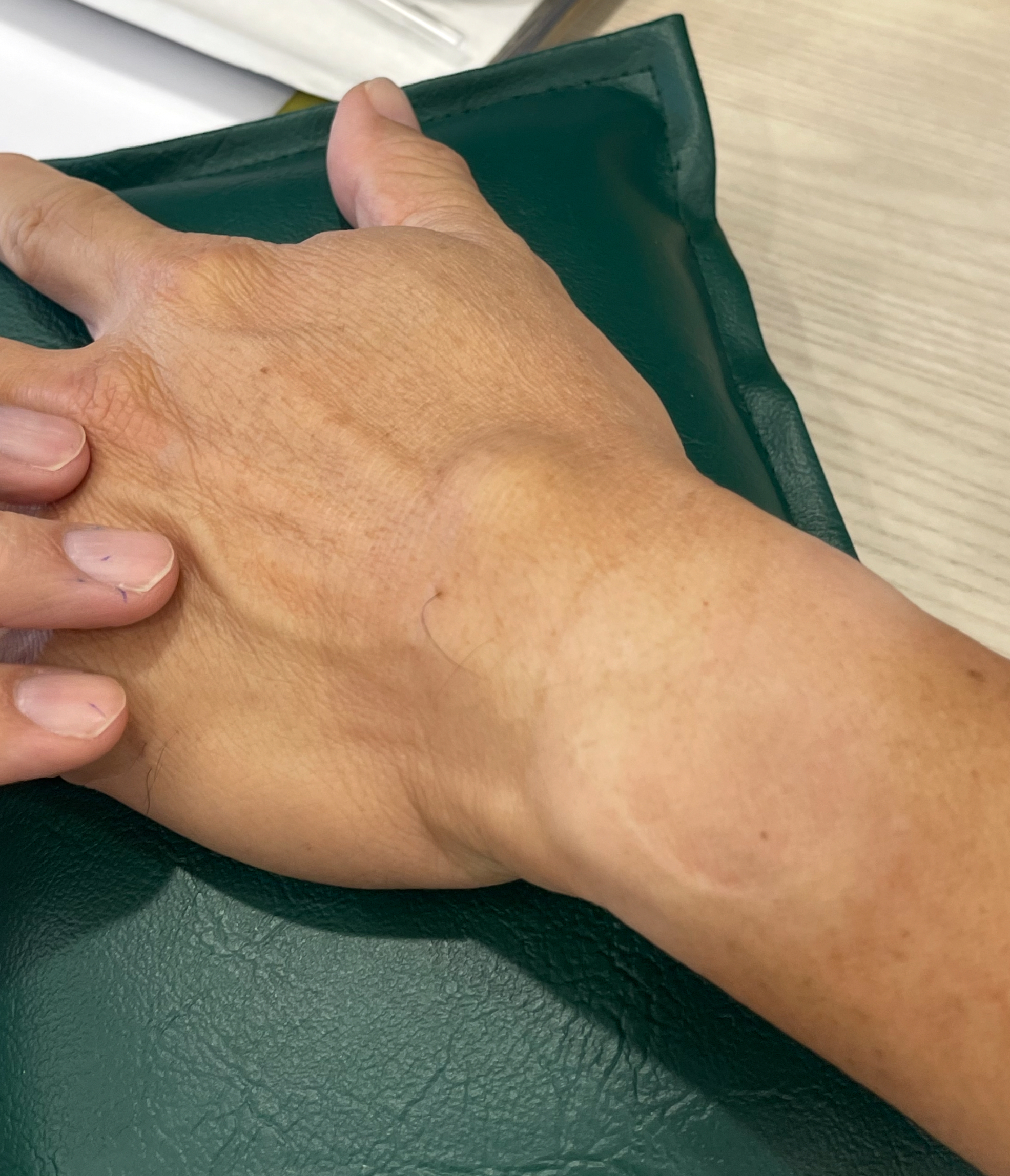 ก้อนถุงน้ำหลังมือ 1 เดือน – แค่รอให้ยุบเอง หรือควรพบแพทย์?
