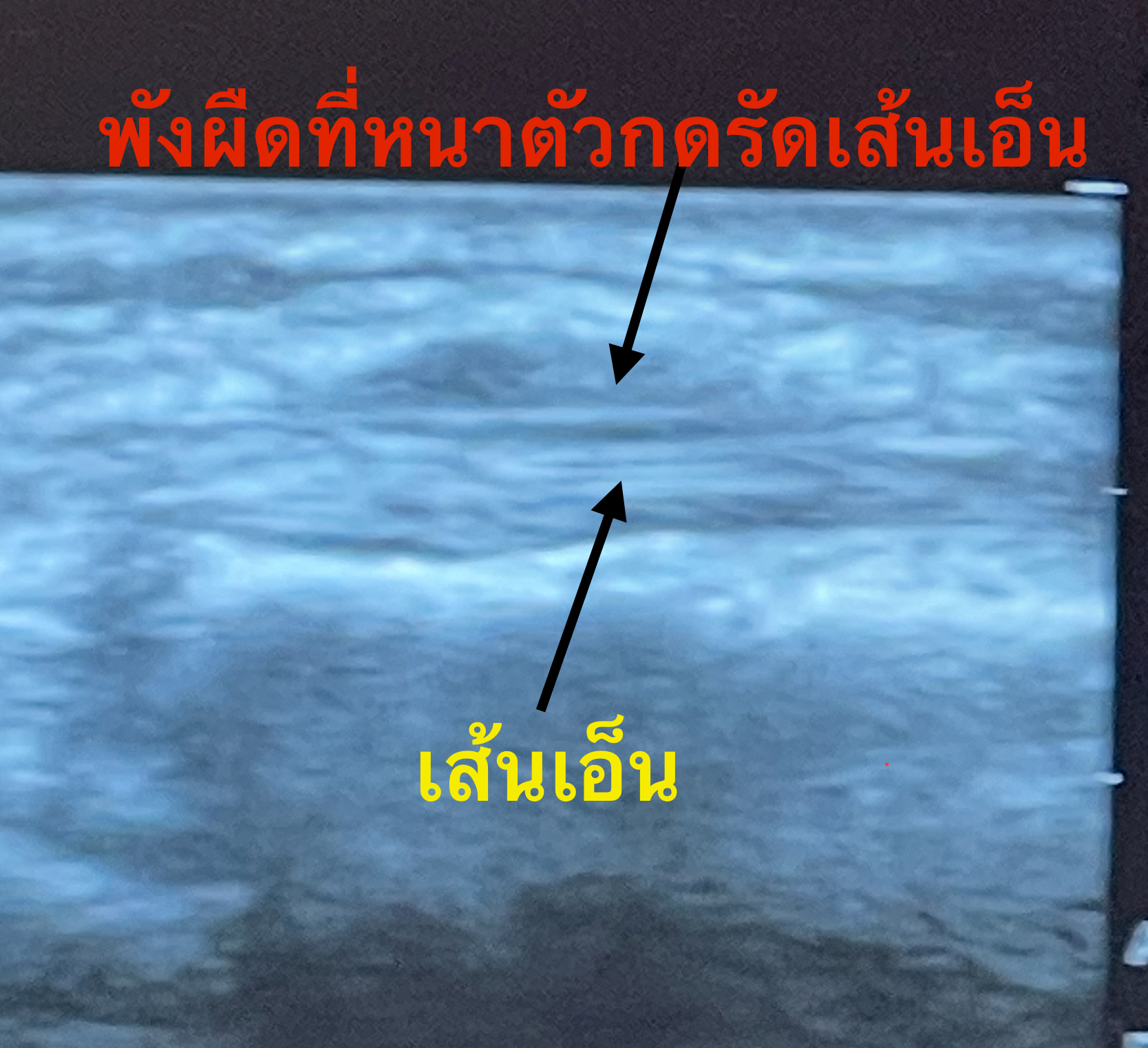 ปวดข้อมือโคนนิ้วโป้ง กายภาพแล้วไม่ดีขึ้น อาจไม่ใช่เพราะทำไม่ถูก แต่เพราะสาเหตุอยู่ลึกกว่านั้น!