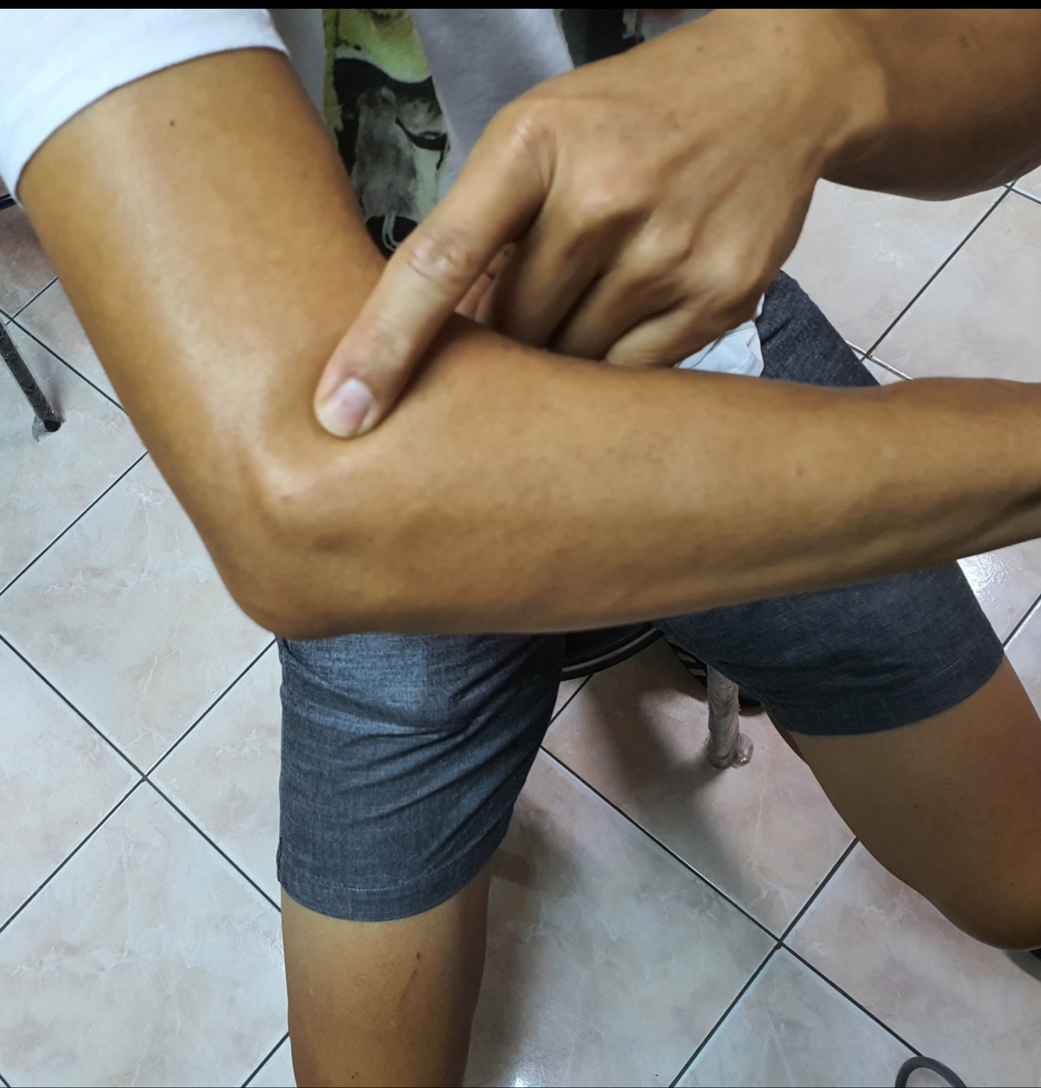 ปวดข้อศอกด้านนอก (Tennis Elbow) — ใช้แขนบ่อยจนปวดเรื้อรัง