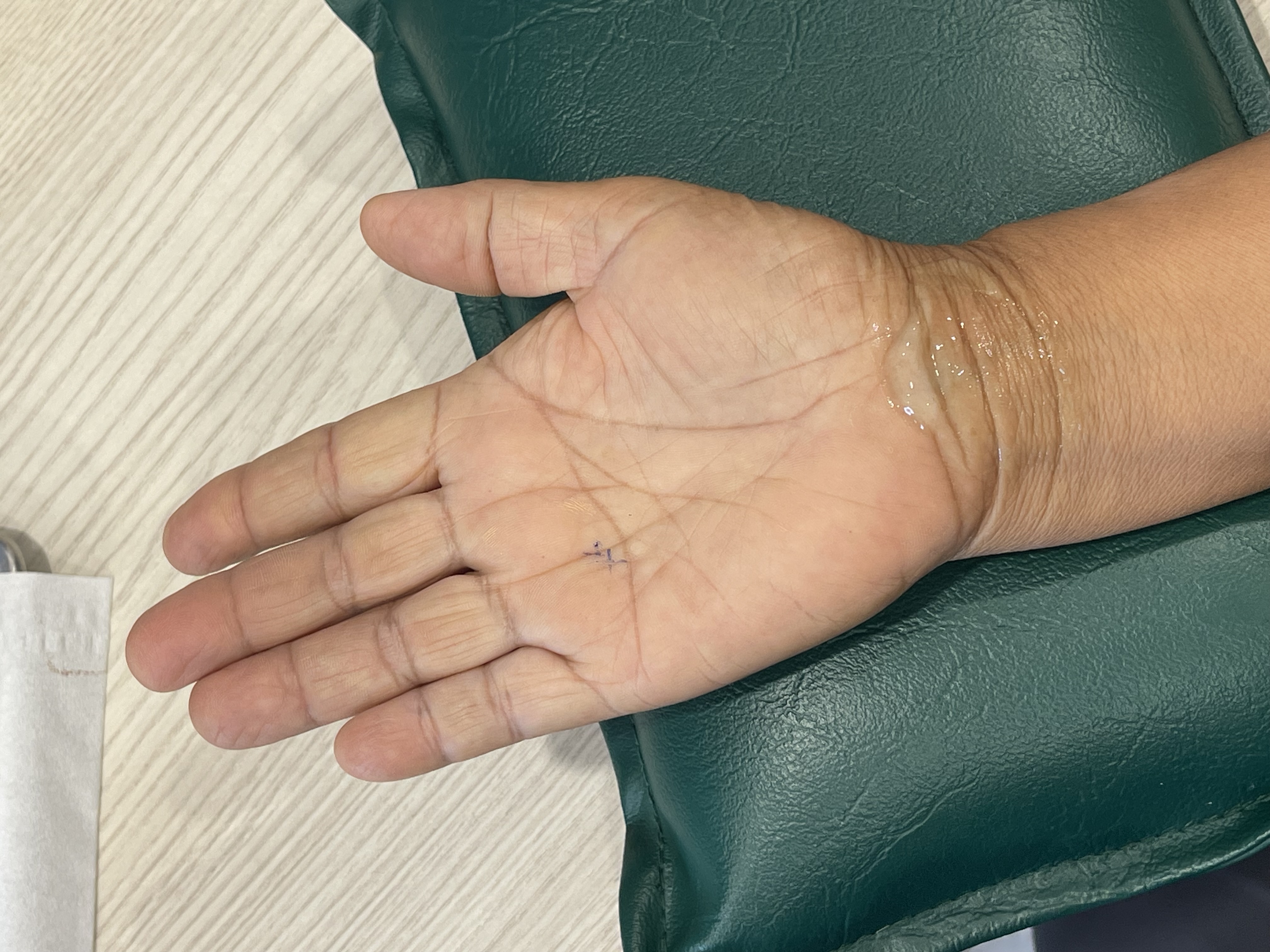 มือชาเฉพาะนิ้วโป้ง นิ้วชี้ นิ้วกลาง = สัญญาณเตือนจากข้อมือคุณ