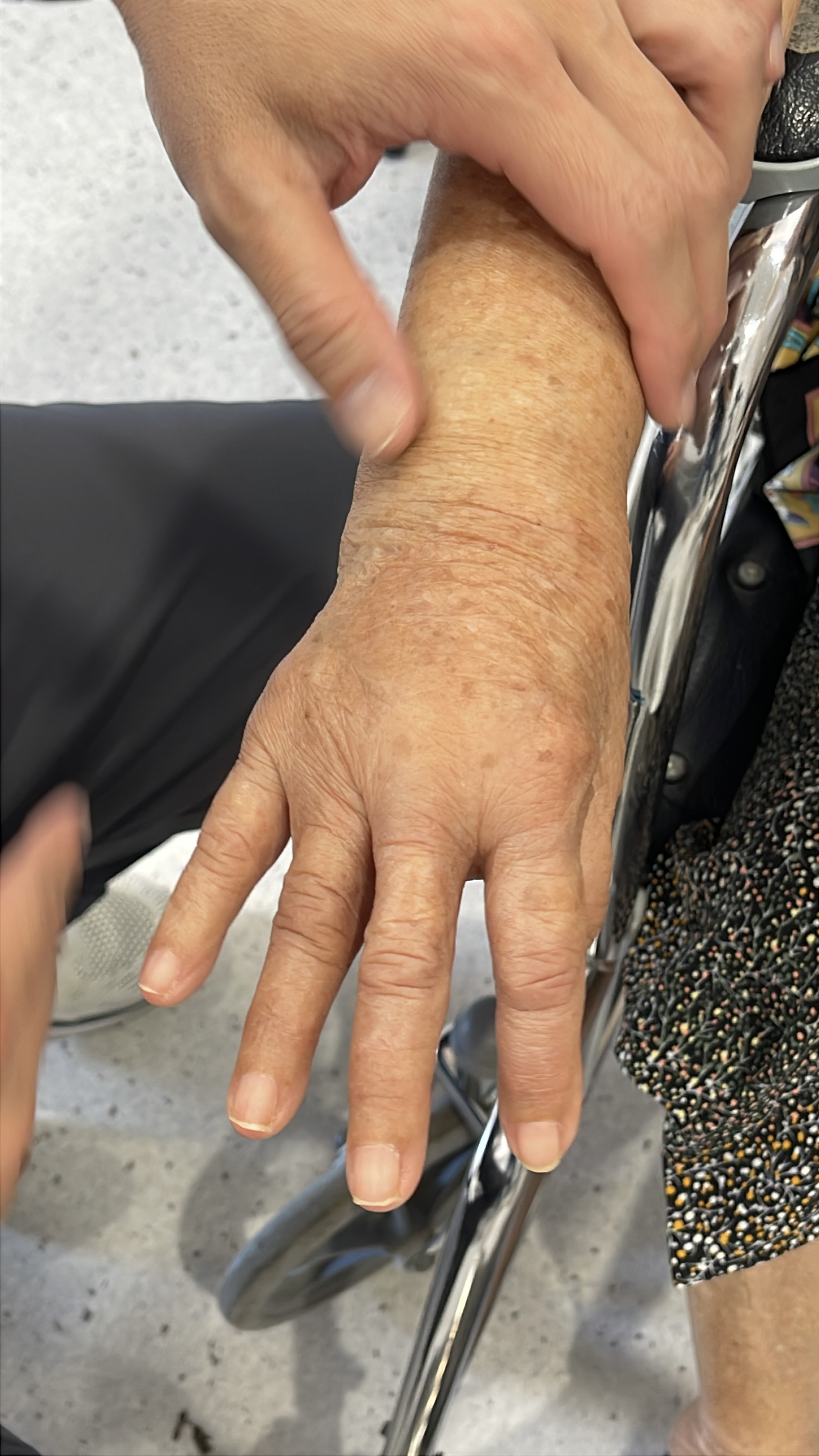 มือบวม ข้อบวมทั้ง 2 ข้าง ระวังโรครูมาตอยด์