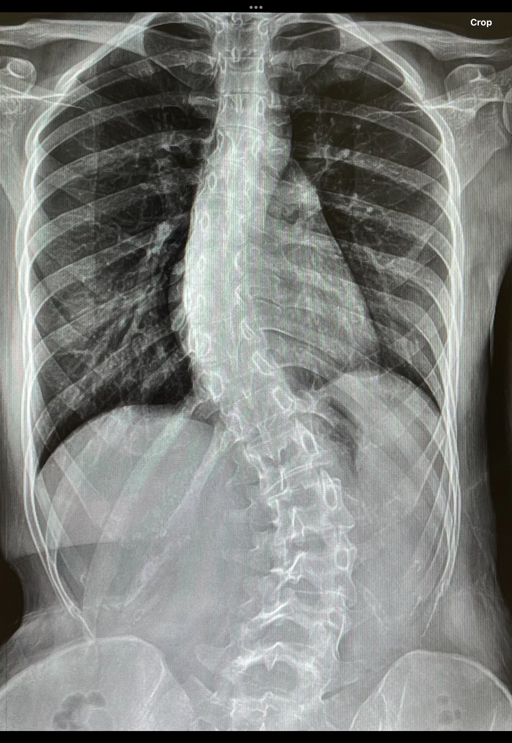 กระดูกสันหลังคด (Scoliosis) เรื่องใกล้ตัวที่ไม่ควรมองข้าม