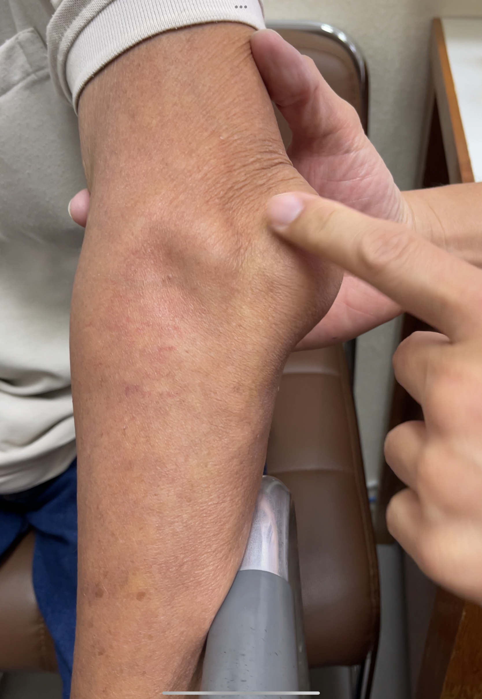 ก้อน Tophi จากเก๊าท์ที่ข้อศอกและนิ้วมือ: ไม่ใช่แค่ปวด แต่คือสัญญาณโรคสะสม