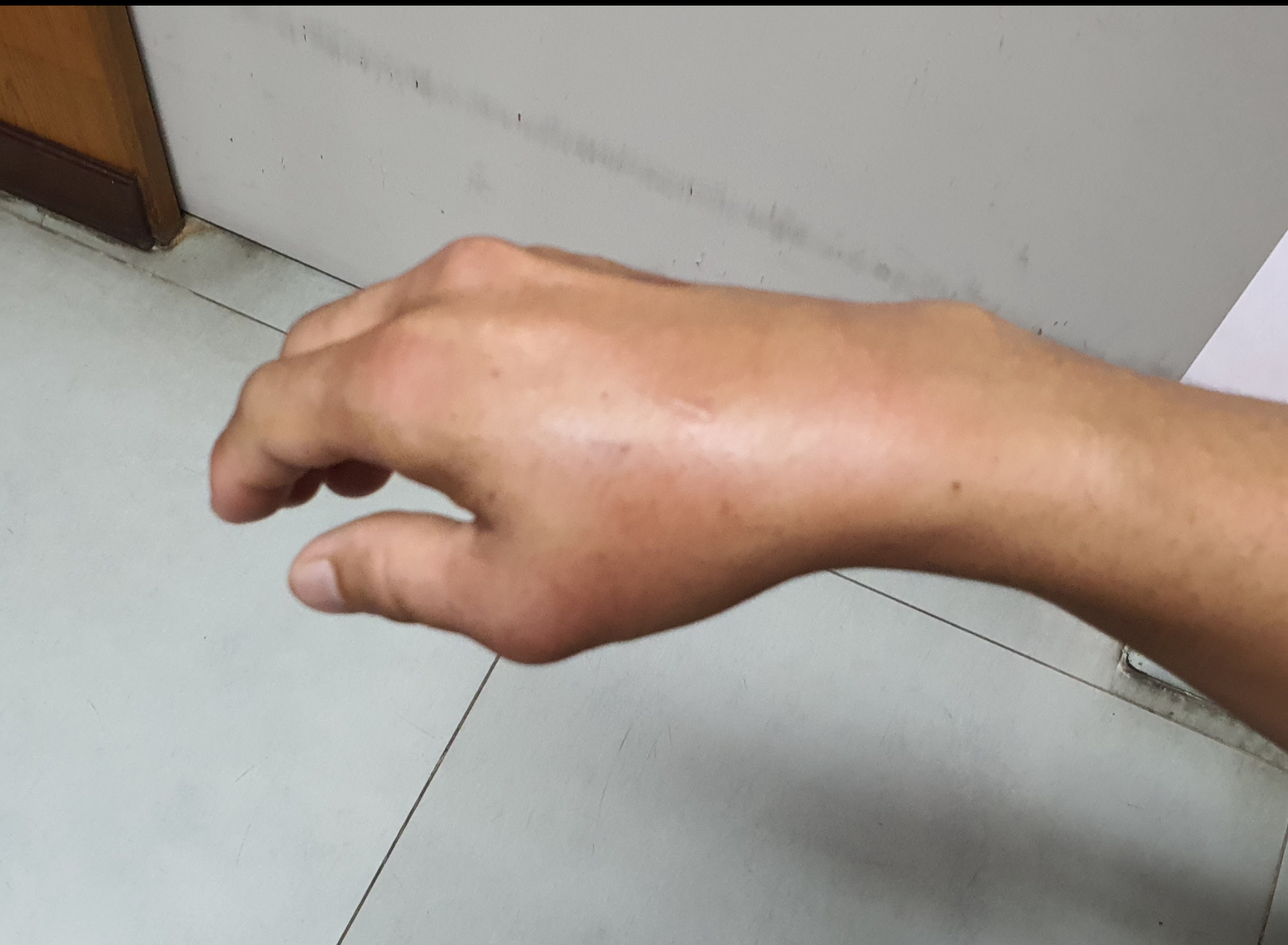 ทำไมบางคนเป็นเก๊าท์แต่ไม่มีก้อน Tophi?