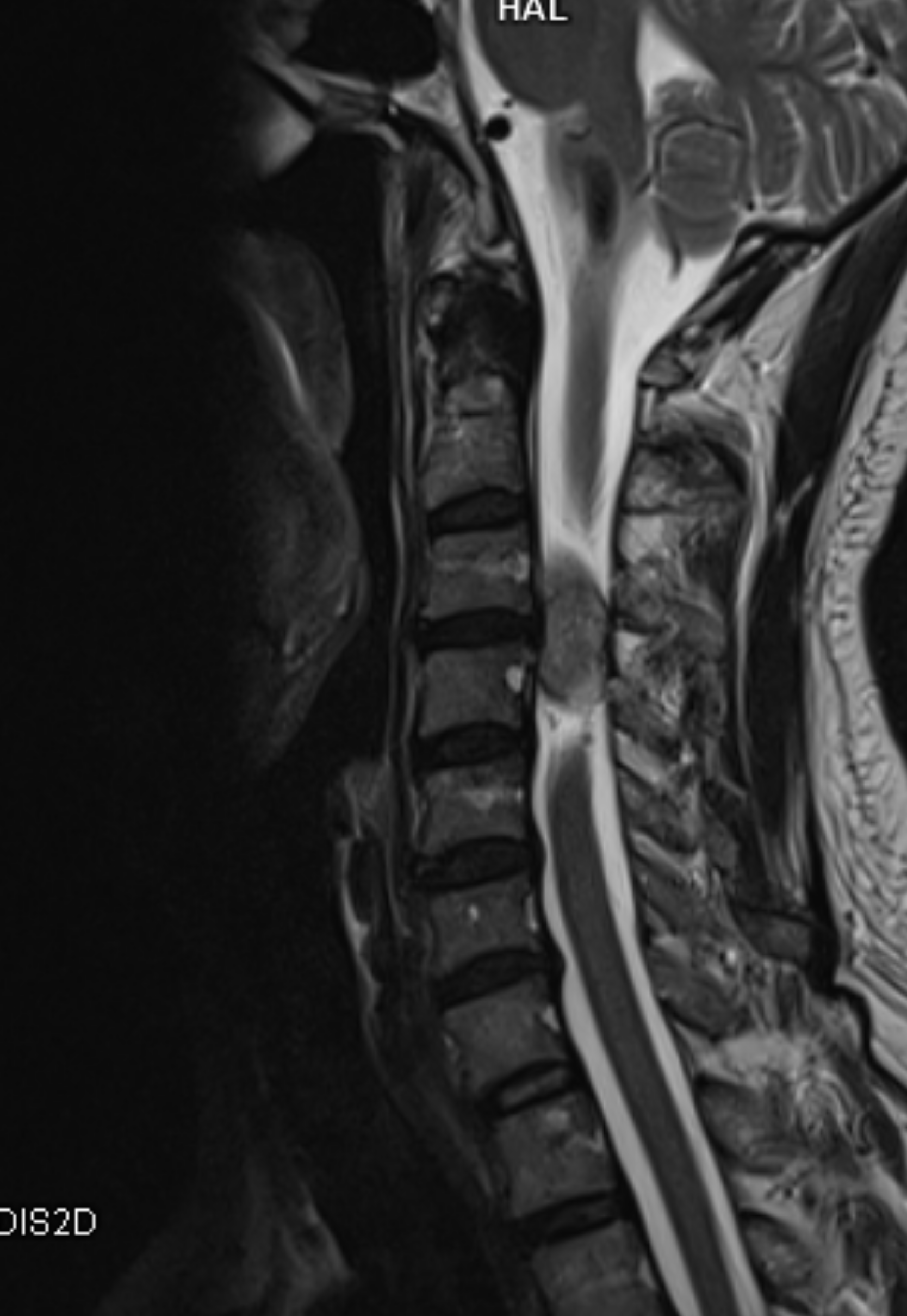อาการชาที่แขนขา…ไม่ควรชะล่าใจ เพราะอาจเป็นสัญญาณของ Schwannoma เนื้องอกหุ้มเส้นประสาท