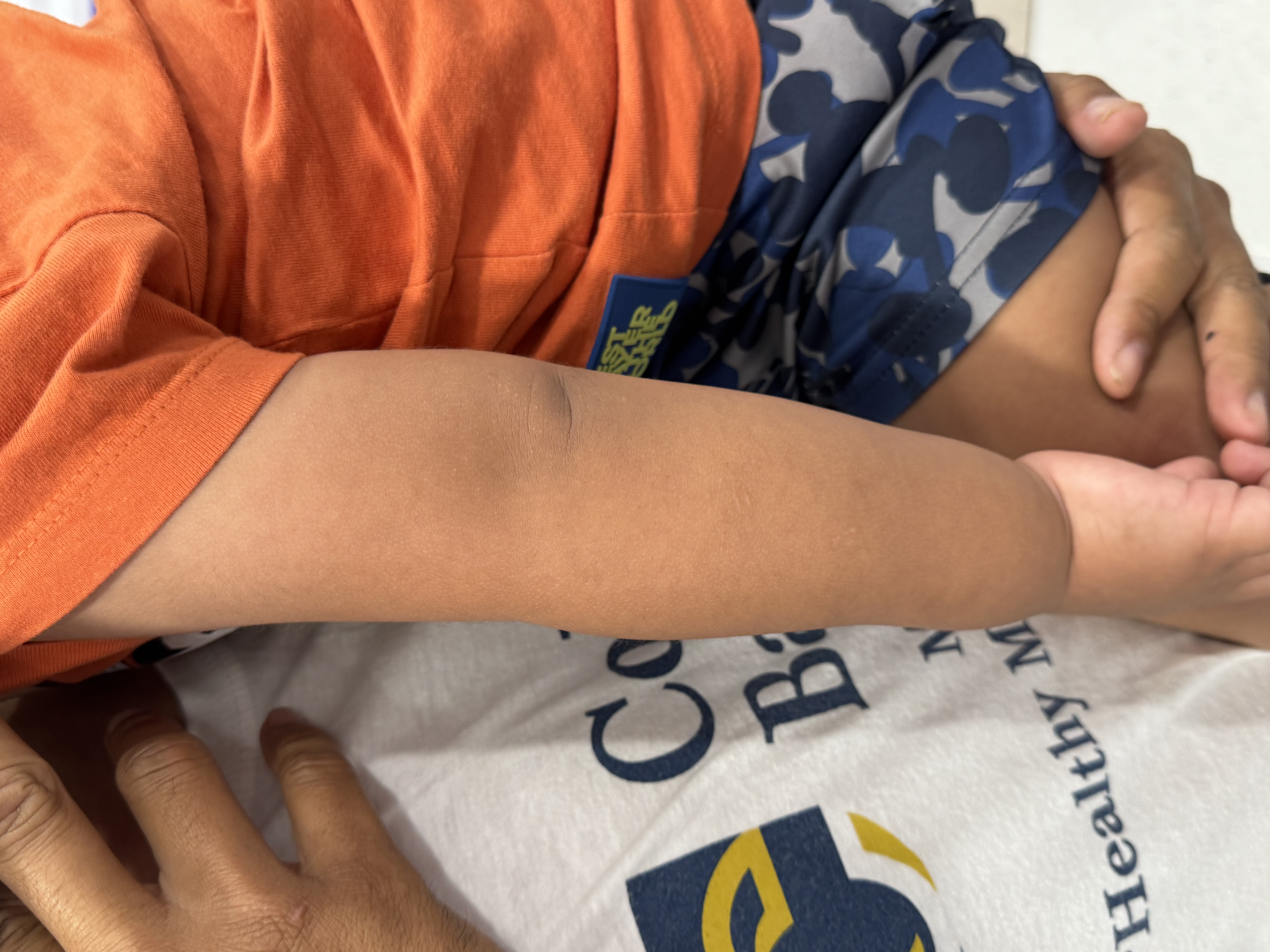 ข้อศอกหลุดในเด็กเล็ก (Pull Elbow) เรื่องใกล้ตัวที่พ่อแม่ไม่ควรมองข้าม