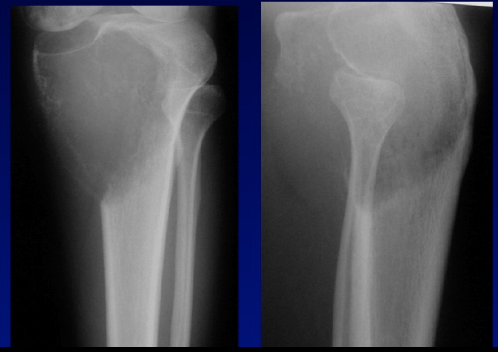 ปวดเข่า…ระวัง “เนื้องอกกระดูกชนิด Giant Cell Tumor”