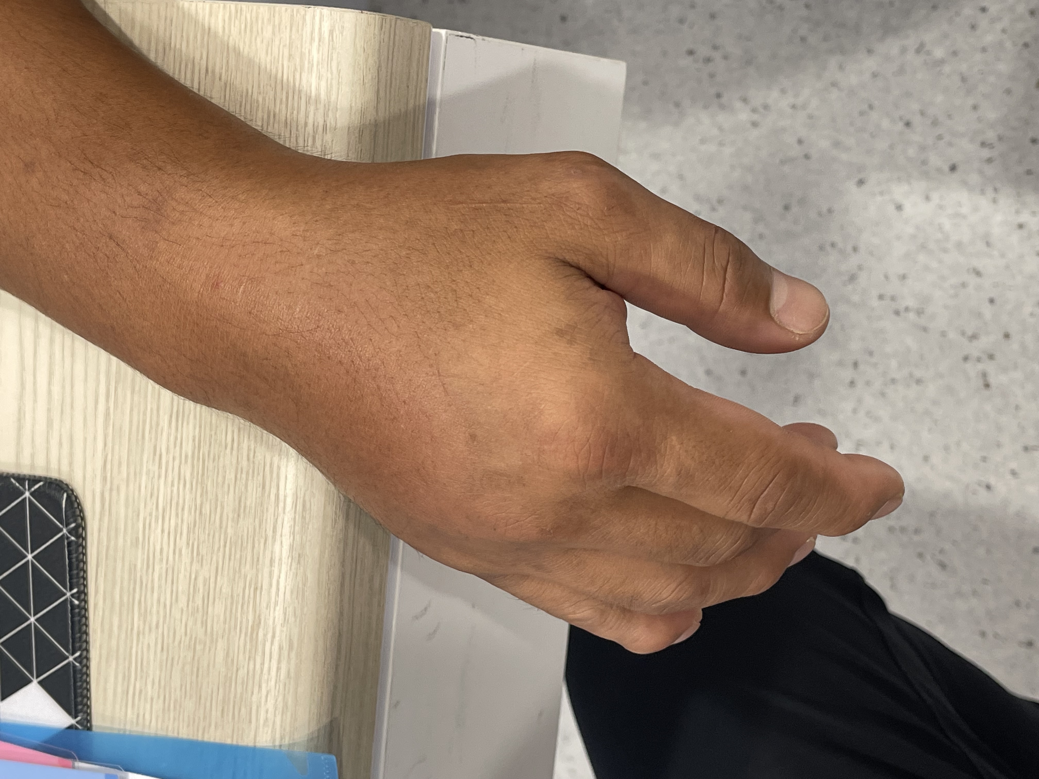 เก๊าท์สามารถเกิดที่ข้อมือได้จริงหรือ? ต่างจากเก๊าท์ที่เท้าอย่างไร