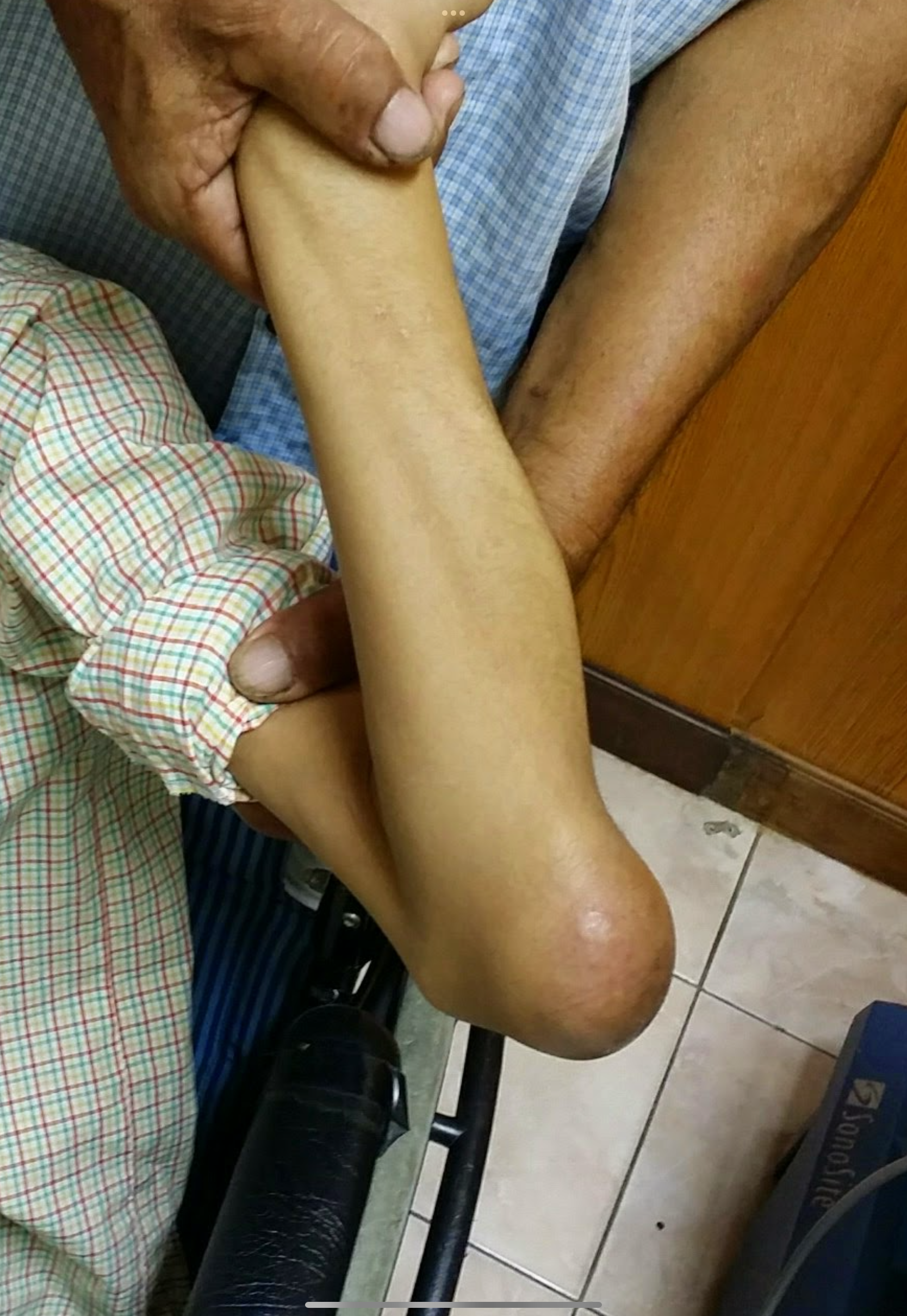 ก้อนบวมที่ข้อศอก…ระวัง “ถุงน้ำอักเสบ” (Olecranon Bursitis)