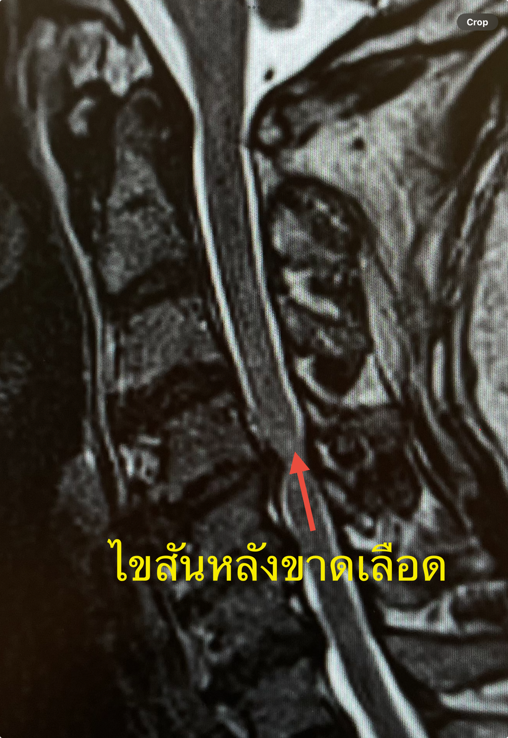 กระดูกคอเสื่อมกดไขสันหลัง (Cervical Spondylosis with Myelopathy) ภาวะอันตรายที่ต้องผ่าตัด