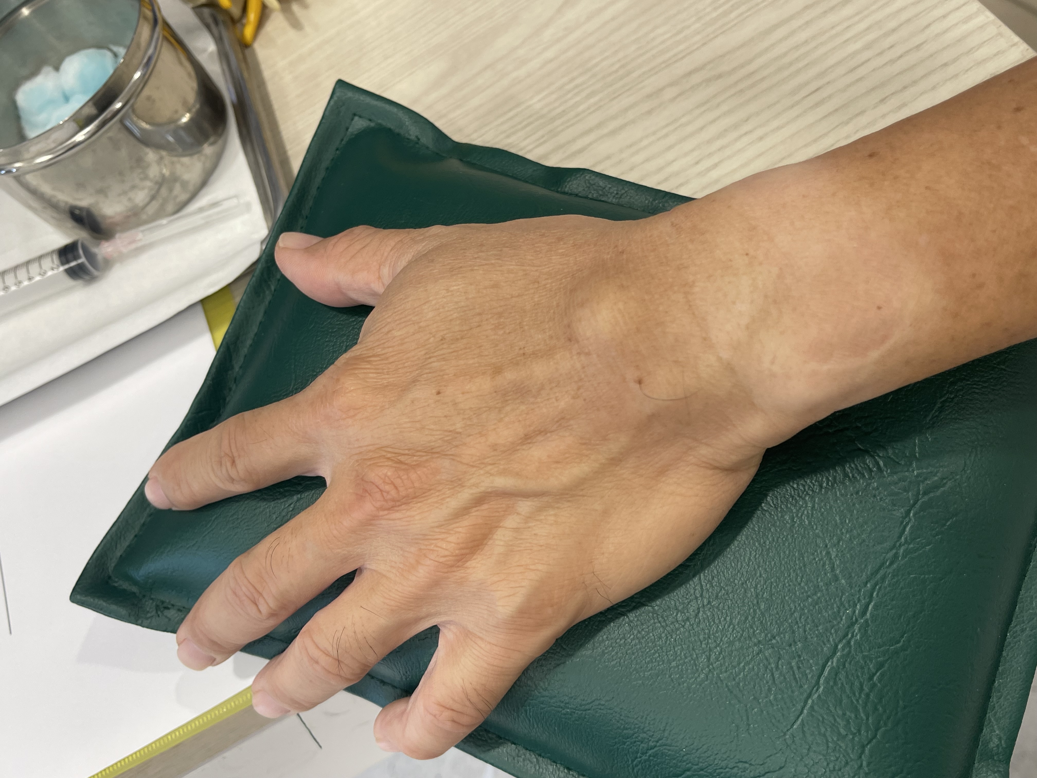 ก้อนถุงน้ำที่หลังมือ Carpal Ganglion Cyst เรื่องใกล้ตัวที่หลายคนกังวล