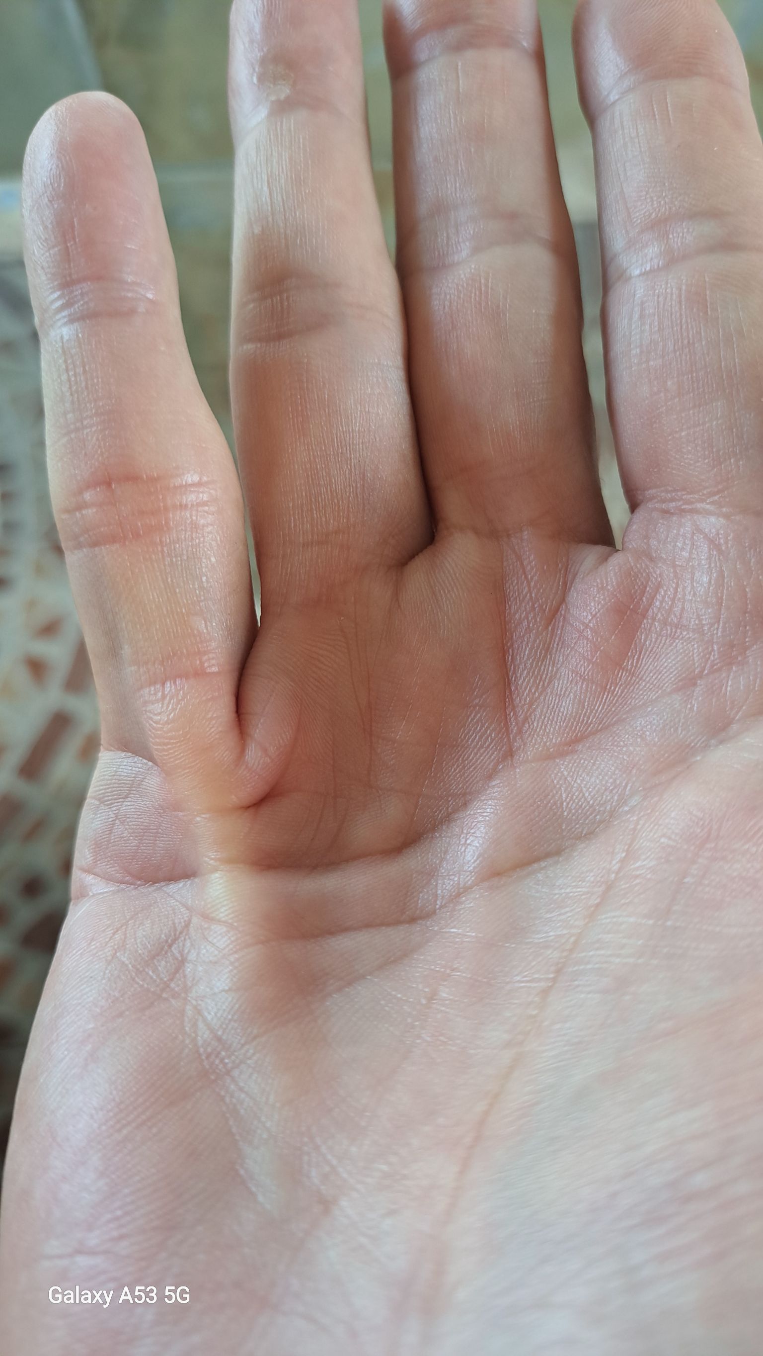 โรคนิ้วงอเหยียดไม่ออก (Dupuytren’s Contracture)