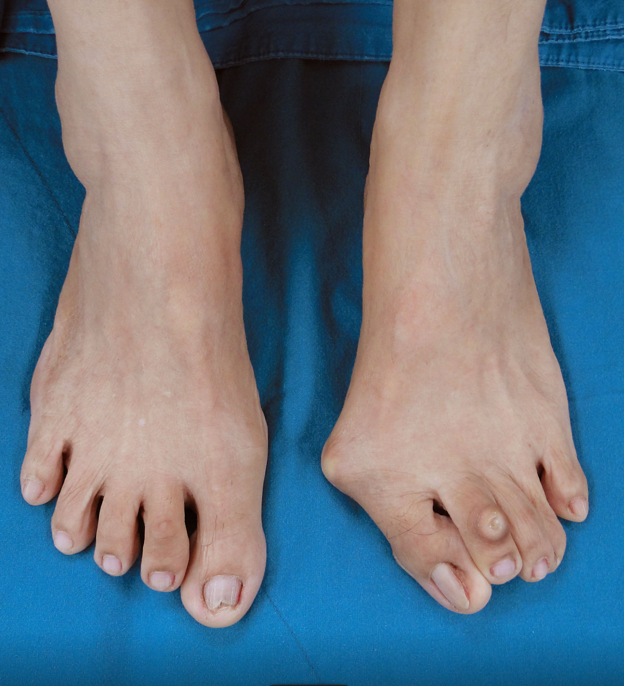 นิ้วเท้าเก (Hallux Valgus) ปัญหากระดูกโปนที่เท้า