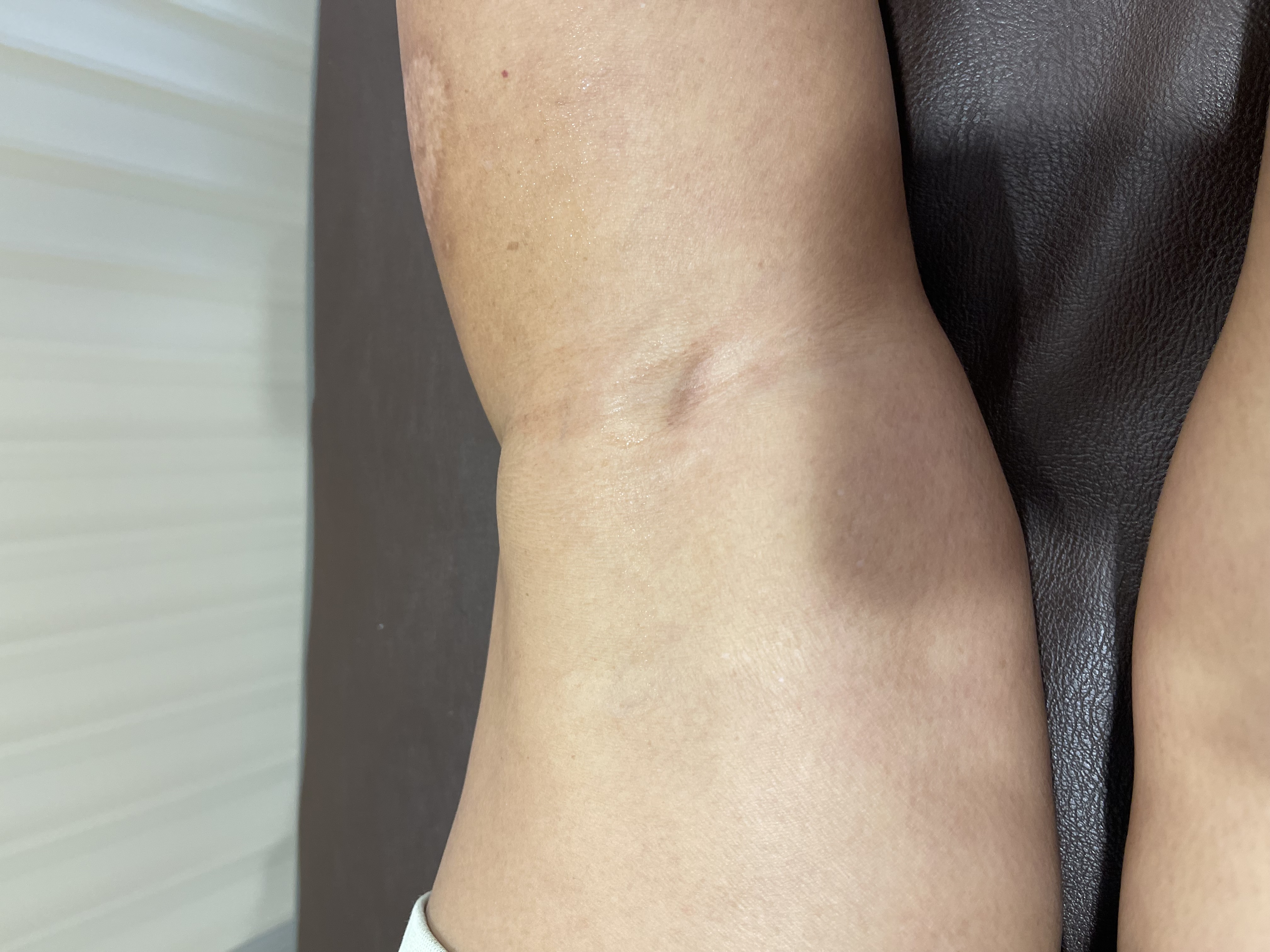 Baker’s Cyst ก้อนบวมด้านหลังเข่า สัญญาณเตือนของปัญหาในข้อเข่า