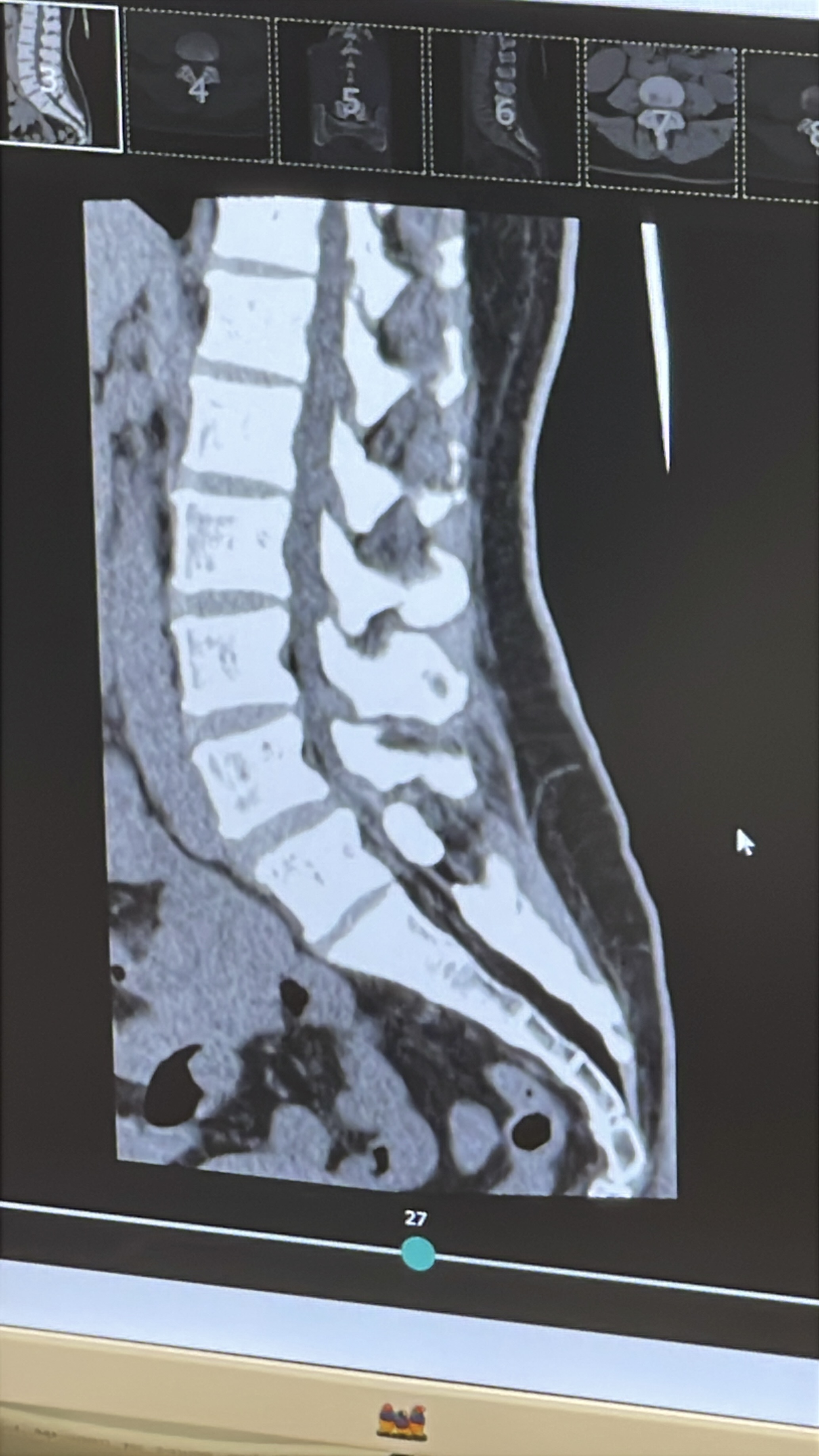 ปวดหลัง ตรวจ CT scan หรือ MRI อะไรเหมาะกว่ากัน?