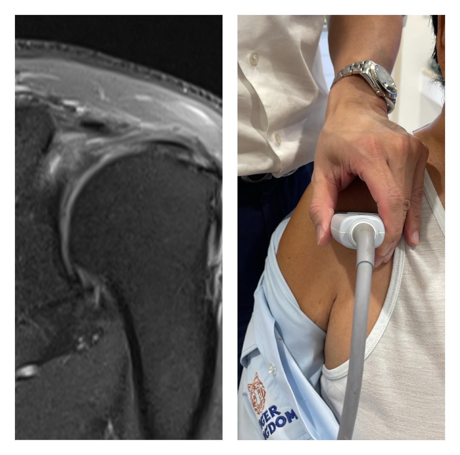 ปวดไหล่ยกแขนไม่ขึ้น ตรวจอัลตราซาวด์เพียงพอหรือควรทำ MRI?
