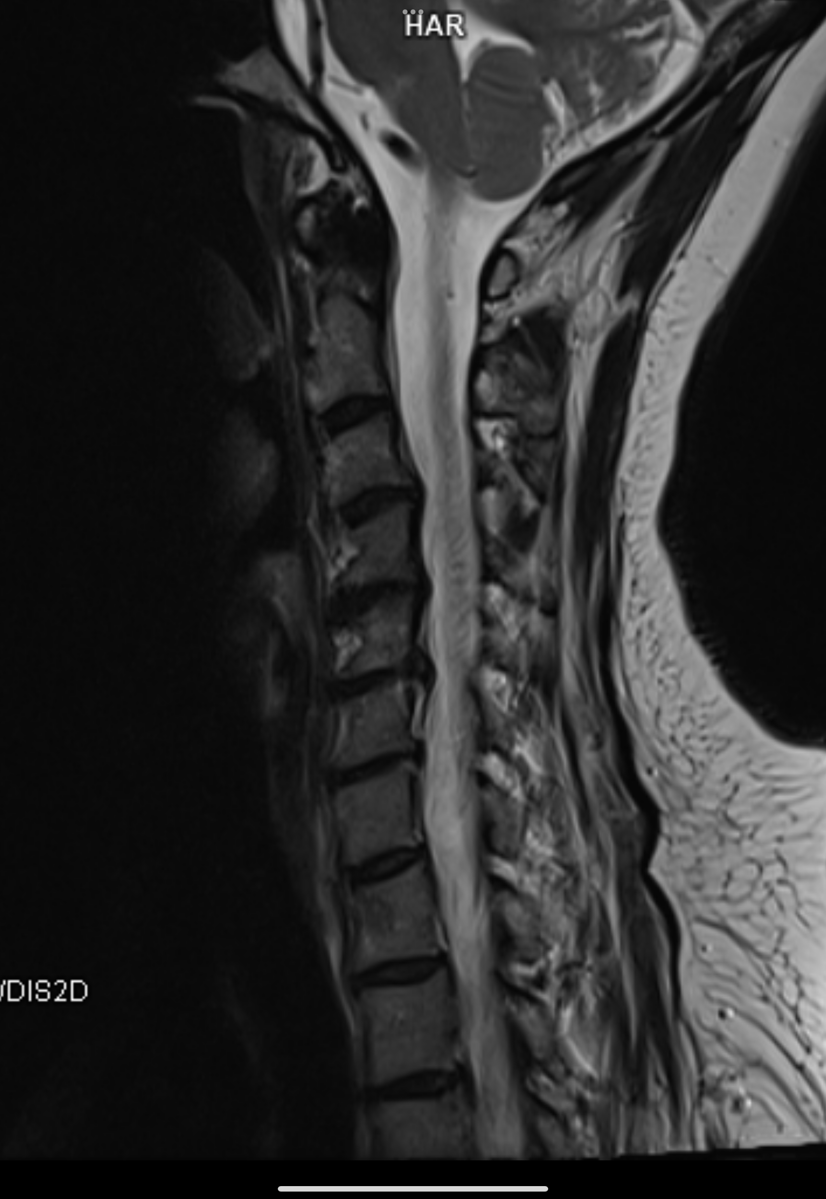 ปวดคอร้าวลงแขน ควรตรวจ MRI หรือ X-ray ถึงจะเห็นชัด?