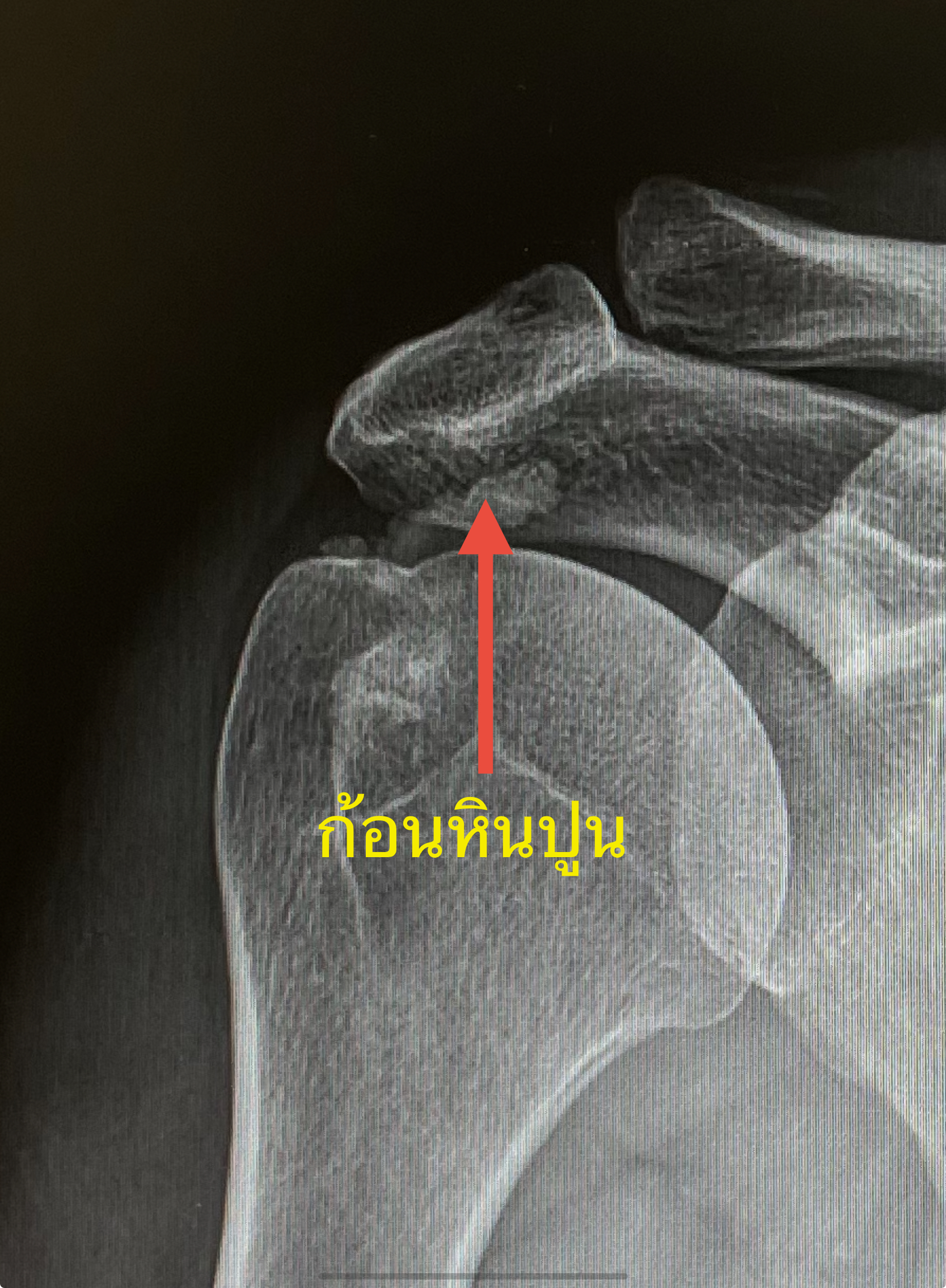 ปวดไหล่ยกแขนไม่ขึ้น…เพราะมีก้อนหินปูน? ใช่โรคร้ายหรือไม่?