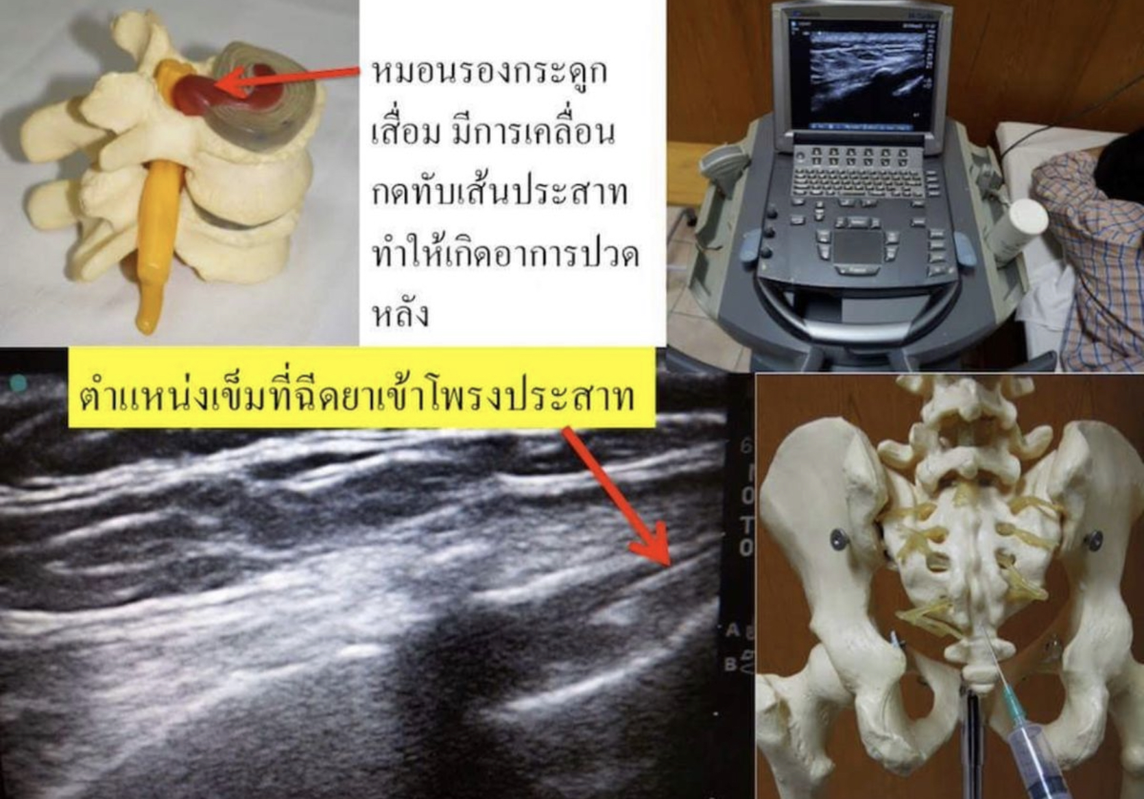ฉีดยาเข้าหลัง ลดอาการปวดหลังจากโพรงประสาทตีบ…คืออะไร? ช่วยได้จริงไหม?