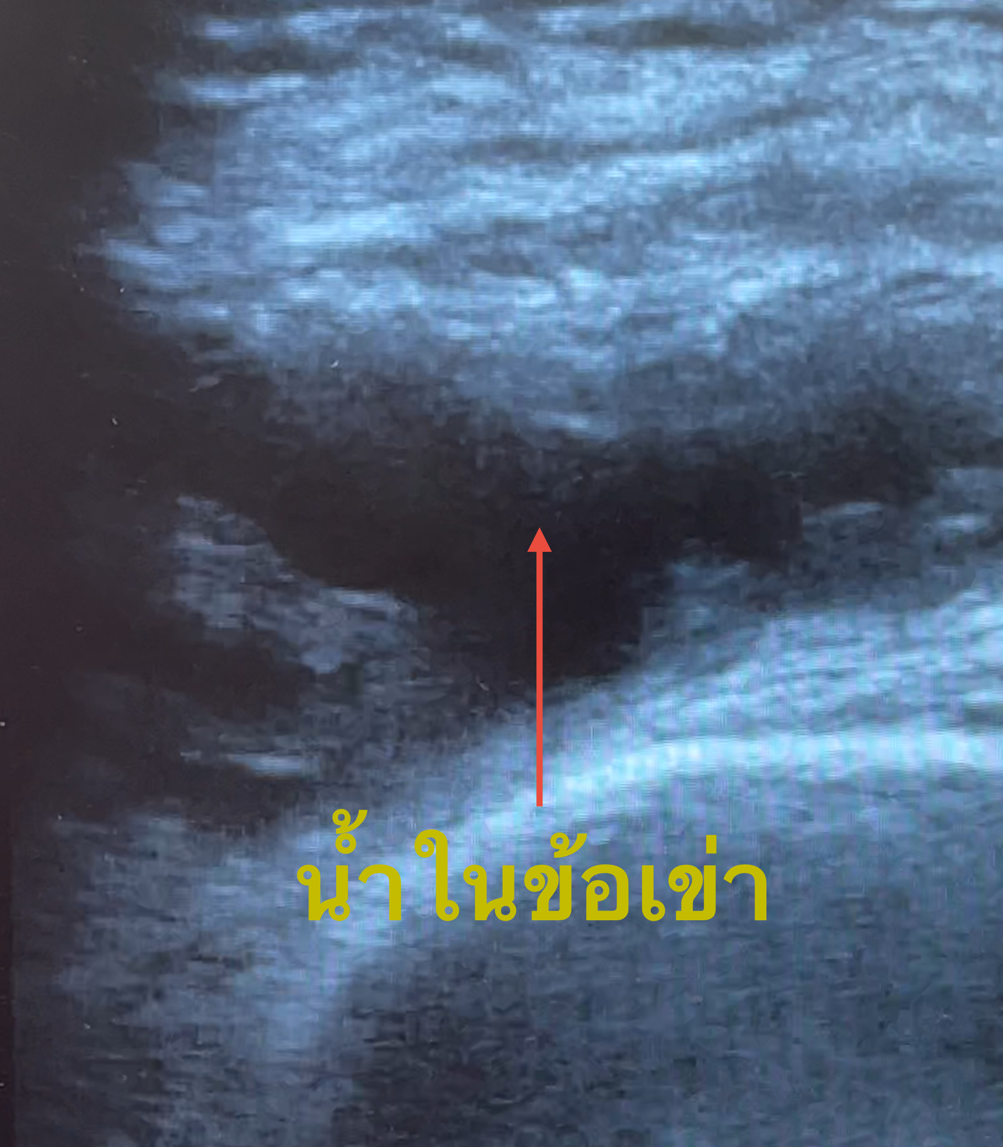 ปวดเข่า ข้อเข่าอักเสบ มีน้ำในเข่า... ต้องดูแลอย่างไร?