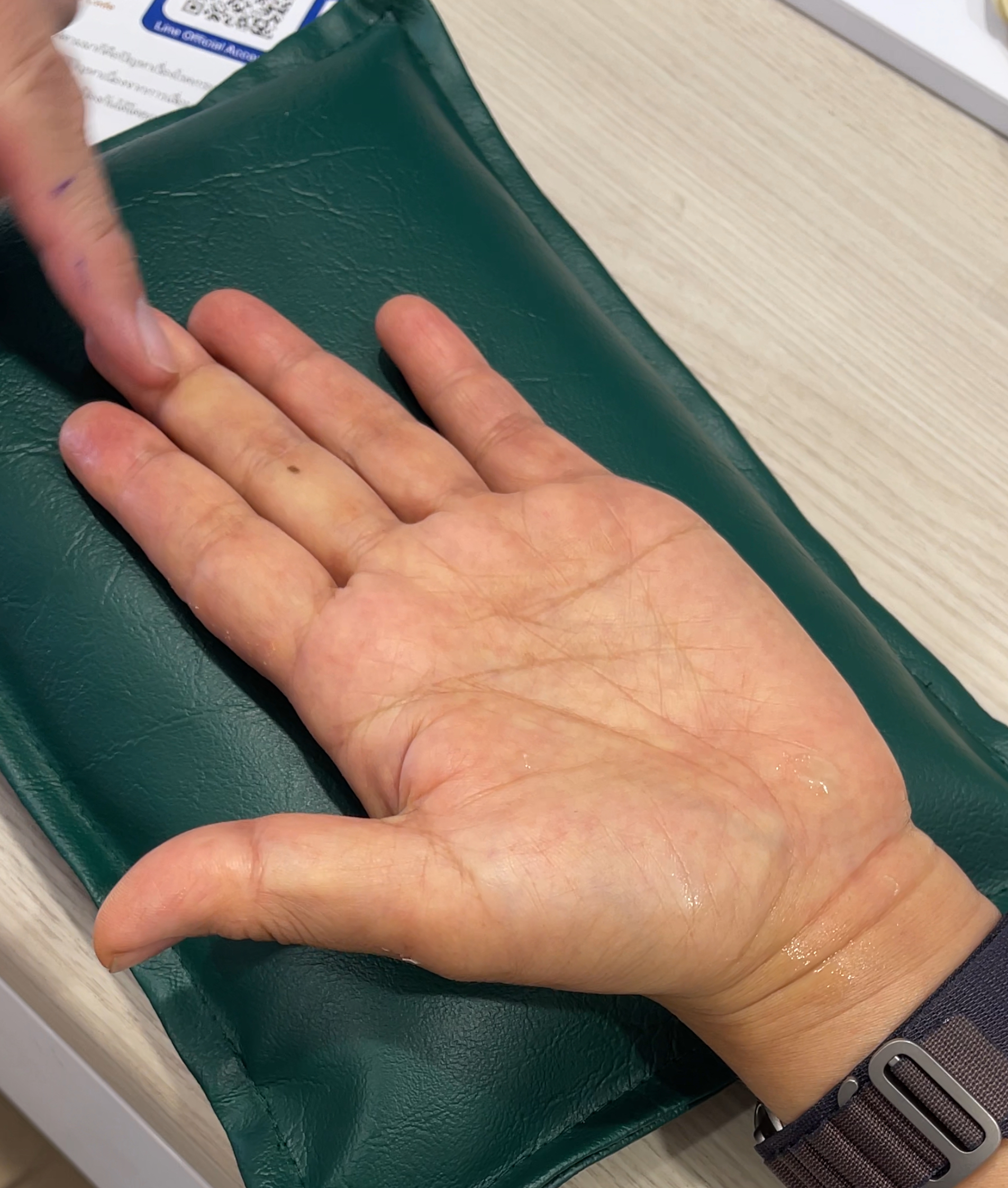 มือชาจากพังผืดกดทับเส้นประสาท ฉีดยา ทานยาแล้วไม่ดีขึ้น... ต้องทำยังไงต่อ?
