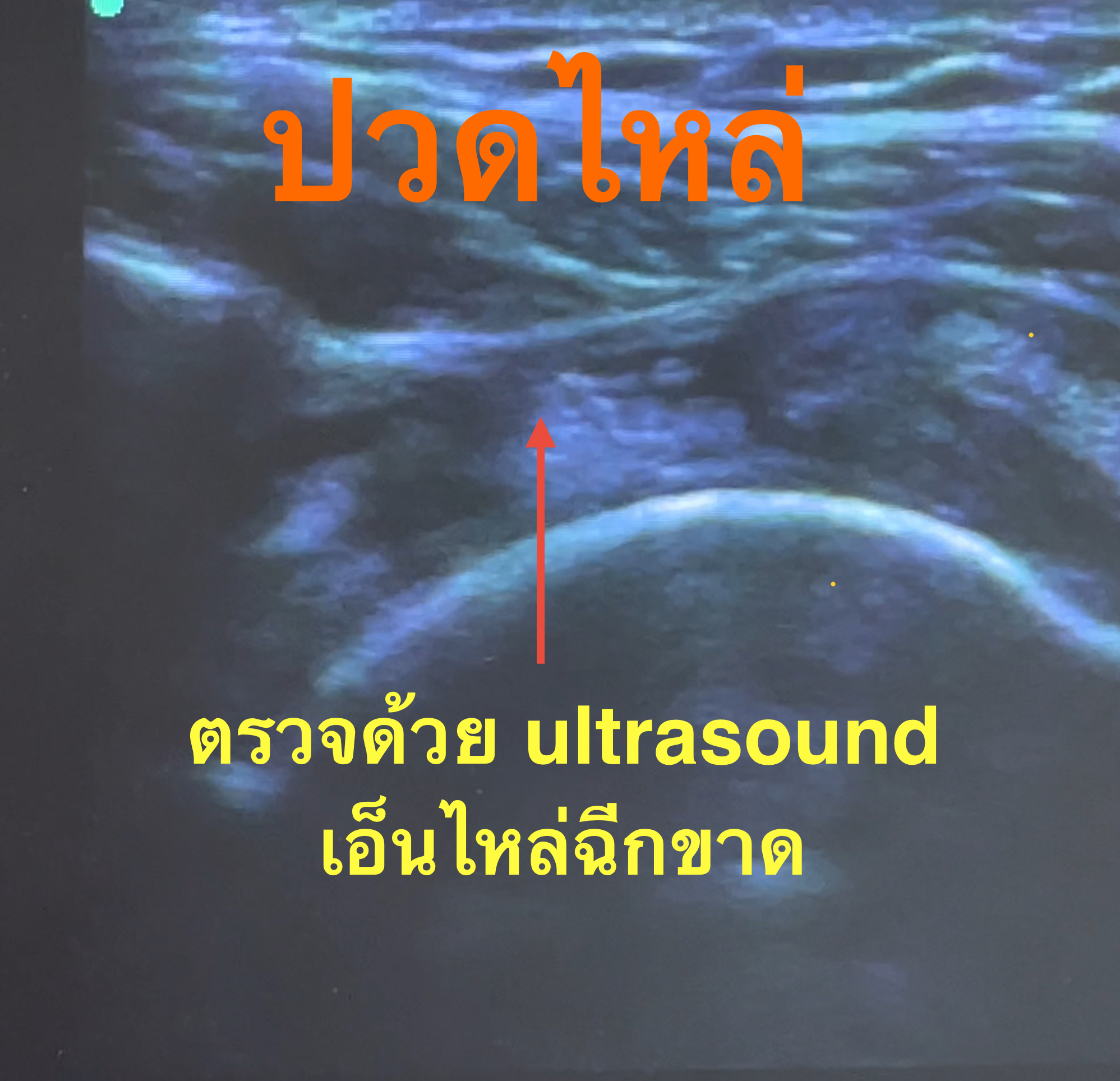 ปวดไหล่เรื้อรัง ตรวจด้วย Ultrasound แล้วพบเส้นเอ็นฉีก... ต้องทำยังไงต่อ?