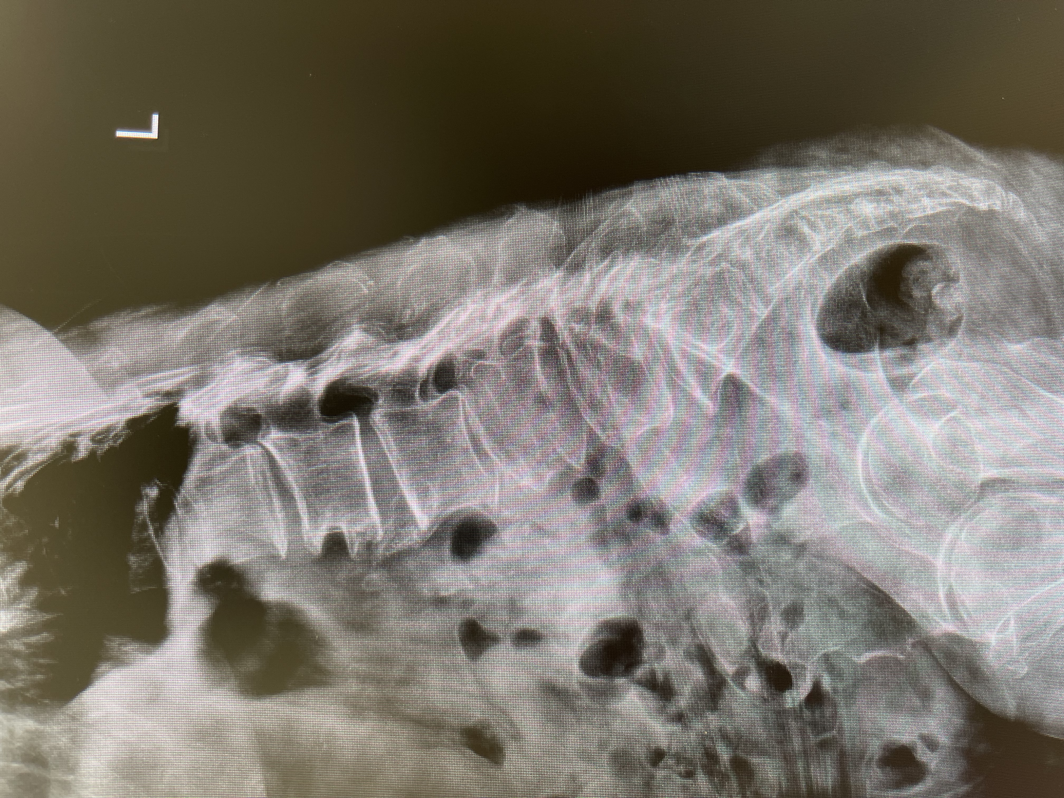 ปวดหลัง ก้าวขาไม่ออก…ระวังโรคช่องกระดูกสันหลังตีบ (Spinal Canal Stenosis)