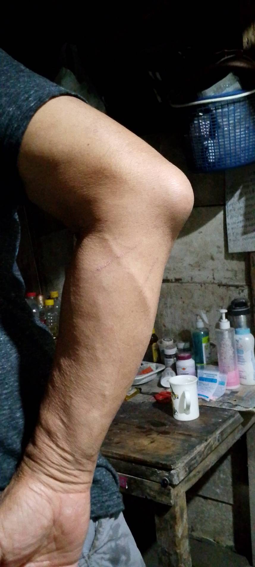 ถุงน้ำใต้ข้อศอก (Olecranon Bursitis): บวมตรงศอก ใช่เก๊าท์หรือเปล่า?