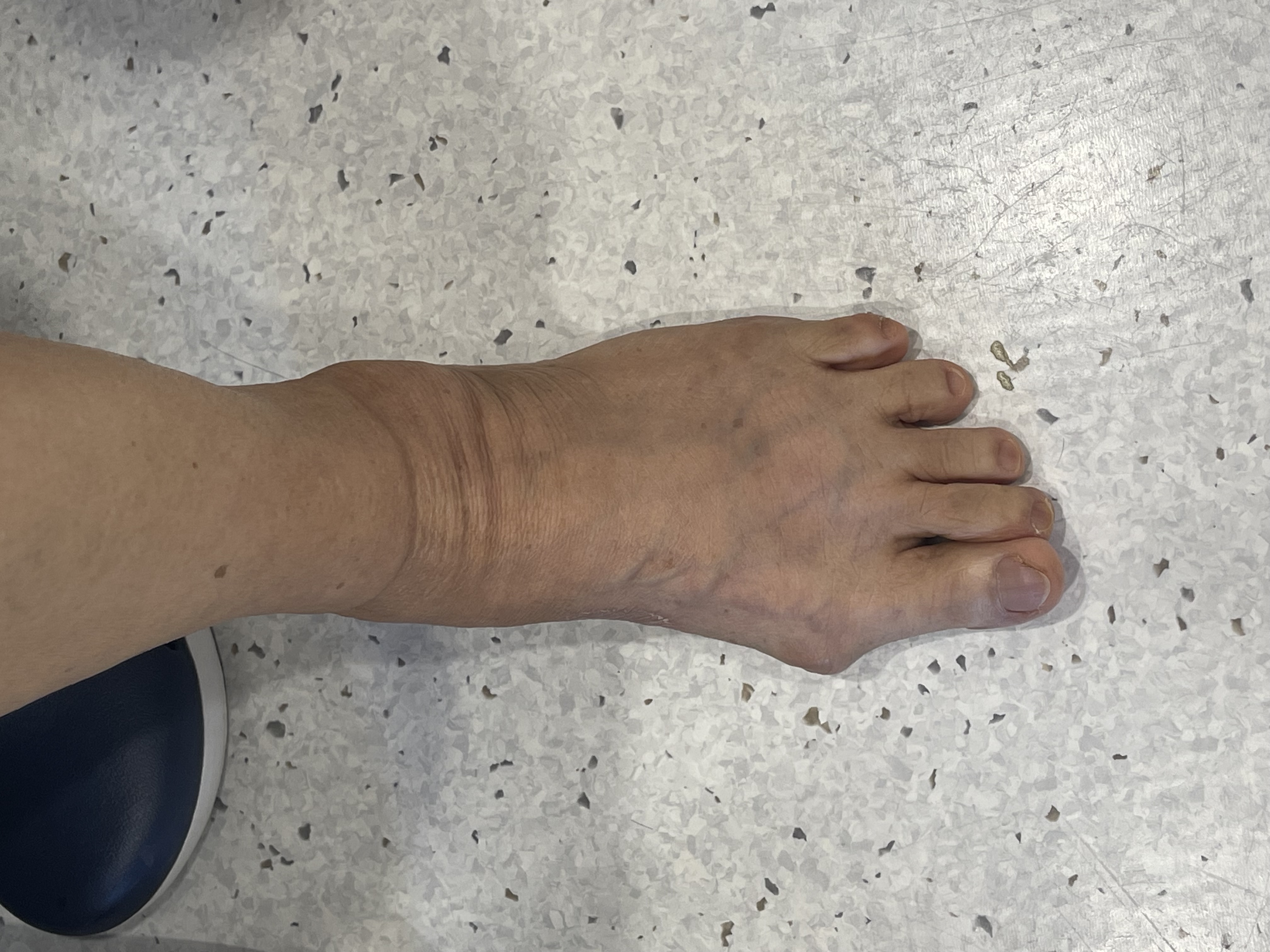 นิ้วโป้งเท้าเก (Hallux Valgus): แค่เรื่องความสวย หรือสัญญาณปัญหาข้อเท้า?