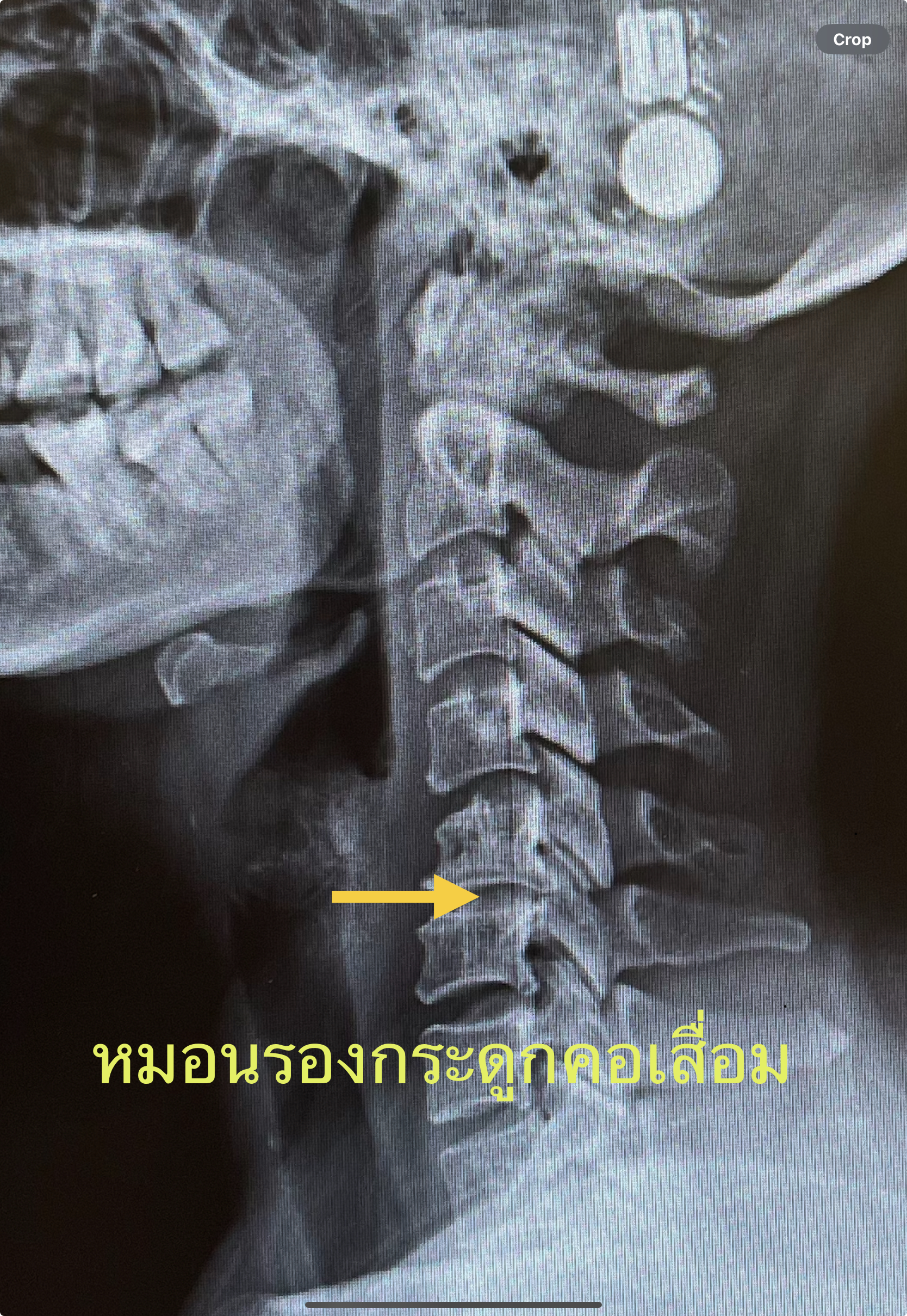 ปวดคอ ร้าวลงแขน ชา ปวดสะบัก หมอนรองกระดูกคอเสื่อม