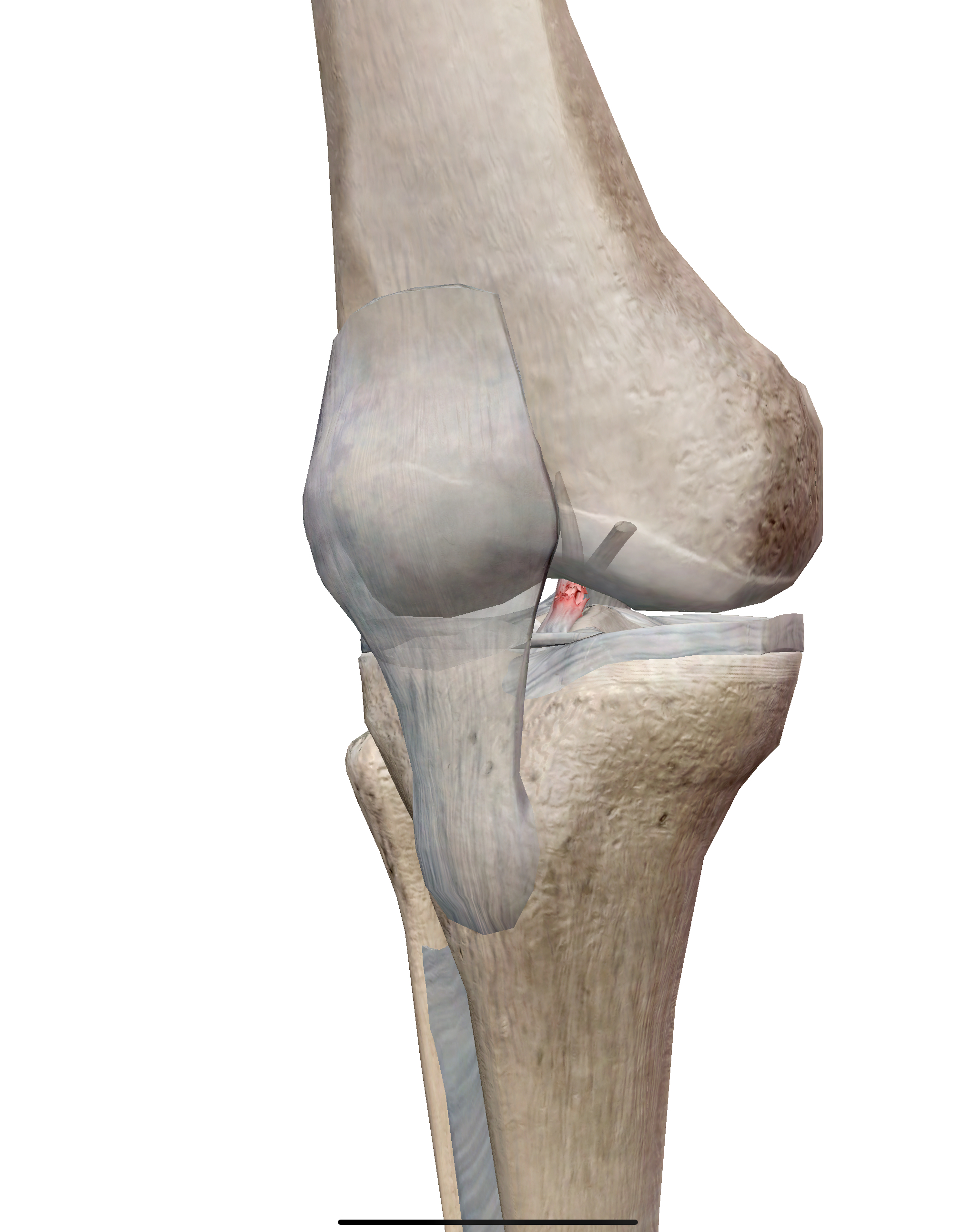 หนุ่มวัย 35 เล่นฟุตบอลแล้วเข่าบวมทันที สุดท้ายเจอว่าเอ็นไขว้หน้า (ACL) ขาด!