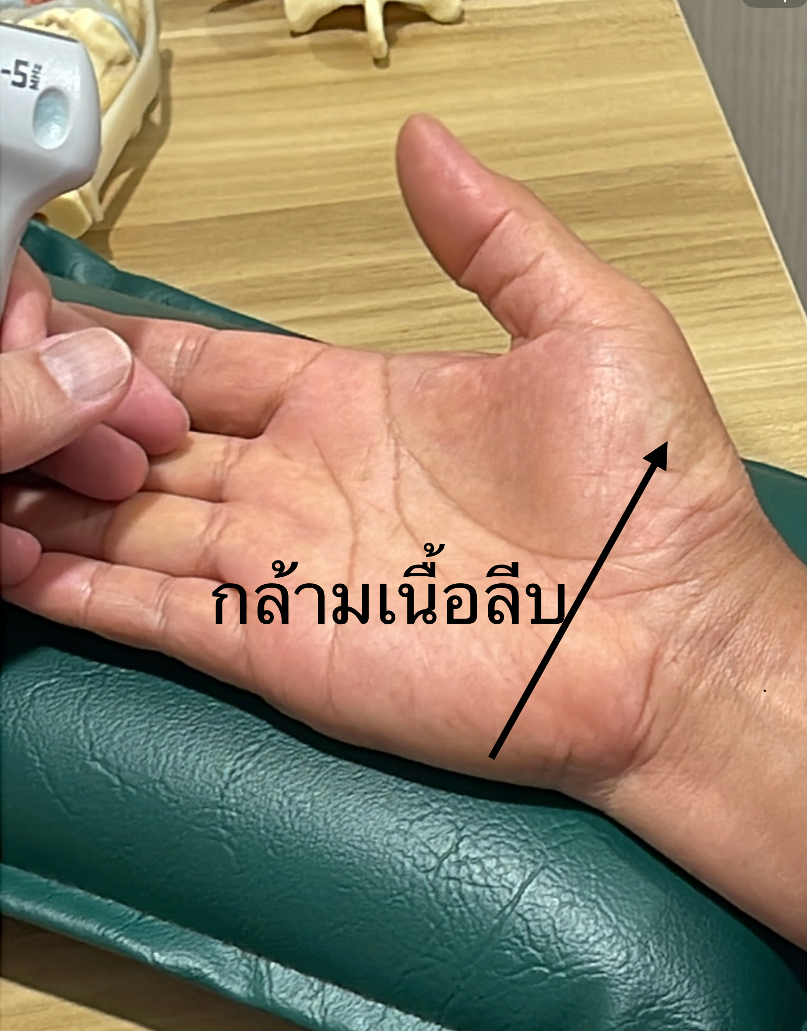 ชามือ นิ้วไม่มีกำลัง กล้ามเนื้อลีบ… อาจไม่ใช่แค่ปวดข้อมือธรรมดา!