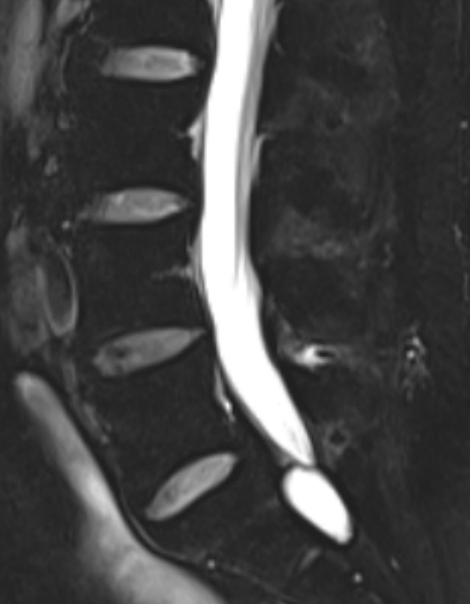 ตรวจ MRI เจอถุงน้ำที่หลัง... จะเป็นมะเร็งไหมคะหมอ?