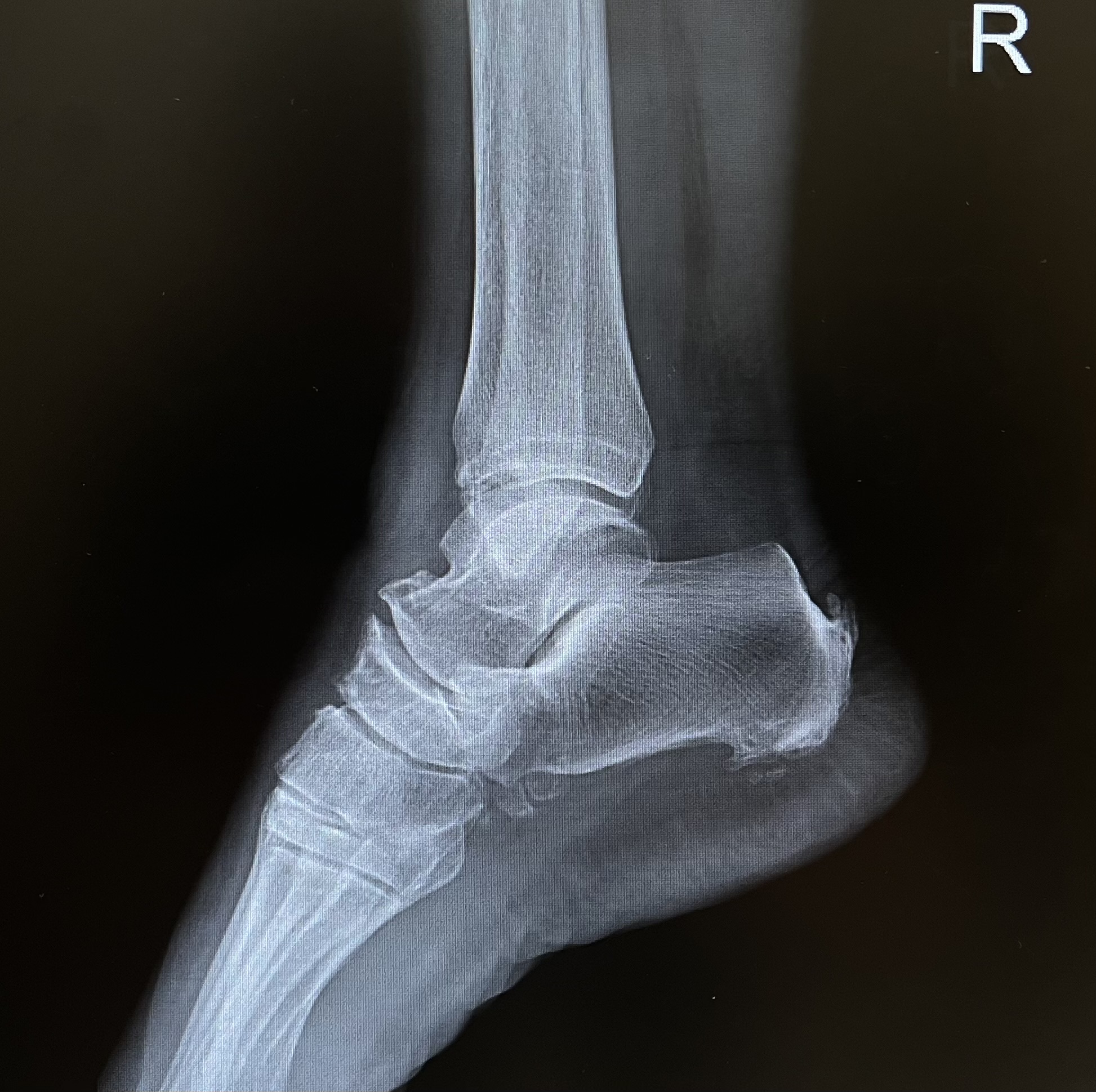 กระดูกส้นเท้างอก (Heel Spur) – ทำไมบางคนเจ็บ บางคนไม่เจ็บ?