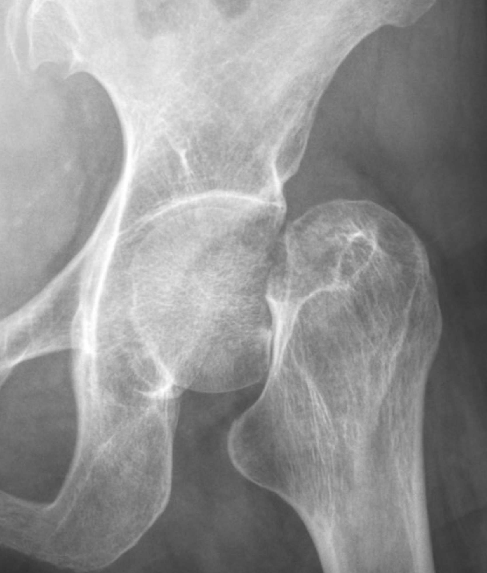 กระดูกสะโพกหัก (Femoral Neck Fracture) – ทำไมต้องรีบผ่าตัด?