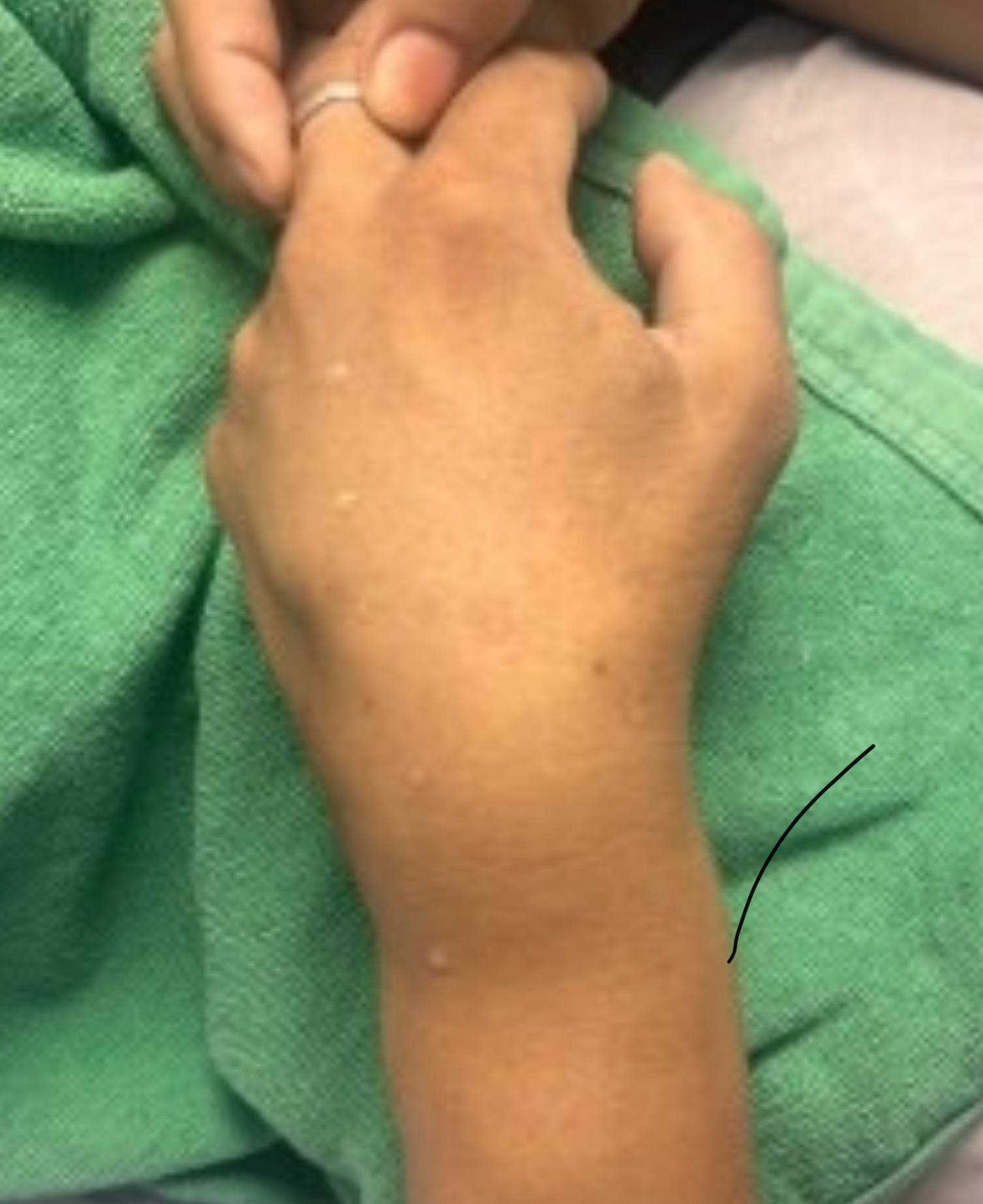 กระดูกข้อมือหัก (Distal Radius Fracture) – หกล้มครั้งเดียว ทำไมถึงหักได้?