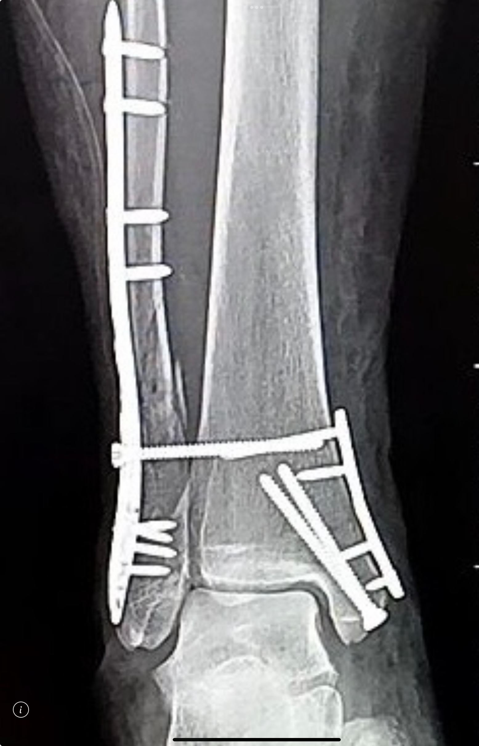 ใส่เหล็ก plate screw จากกระดูกหัก จำเป็นต้องเอาออกหรือไม่?