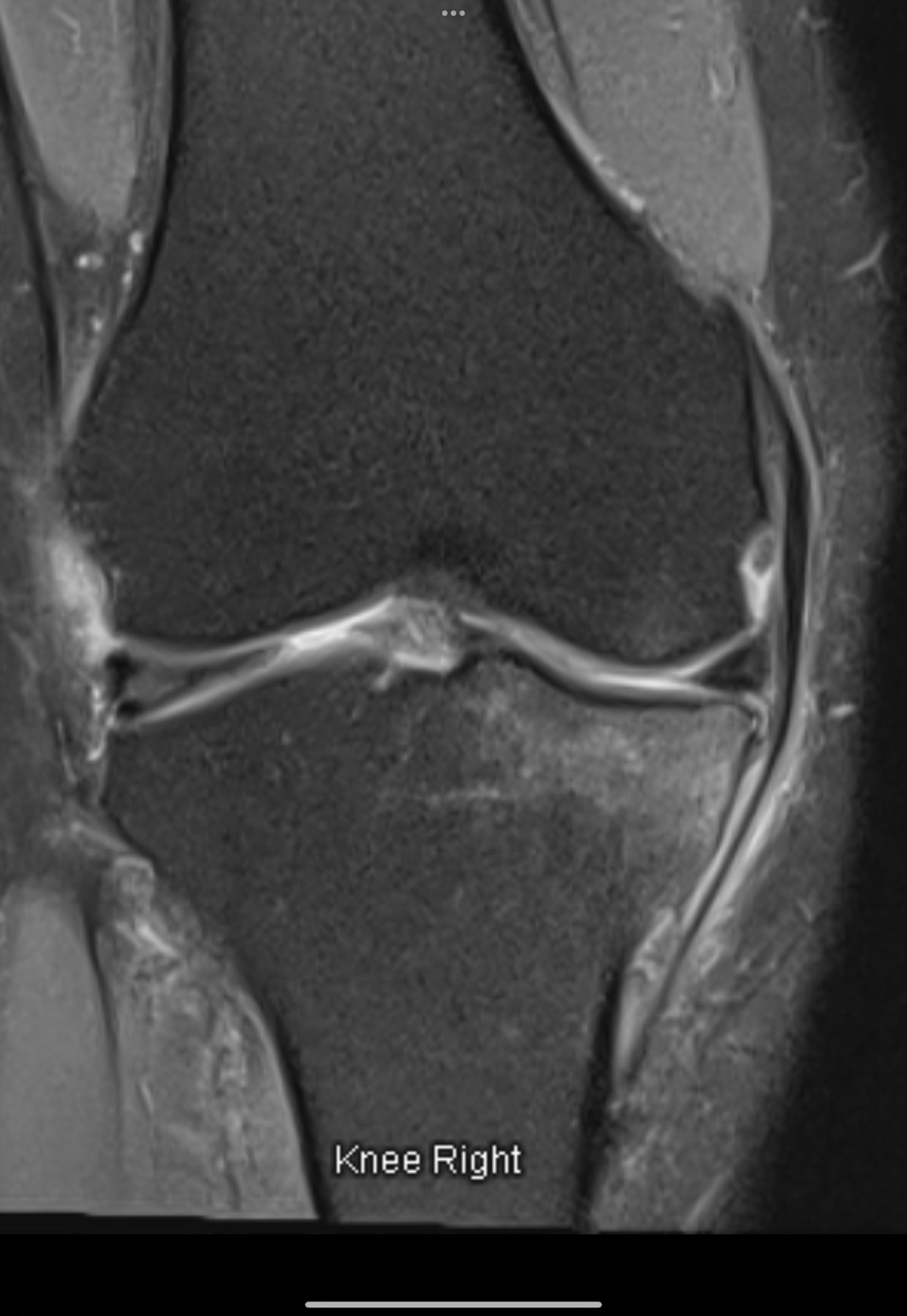 ปวดเข่ามาก เดินลงน้ำหนักยาก…เพราะ “Bone Marrow Edema” ไม่ใช่แค่ข้อเสื่อมธรรมดา
